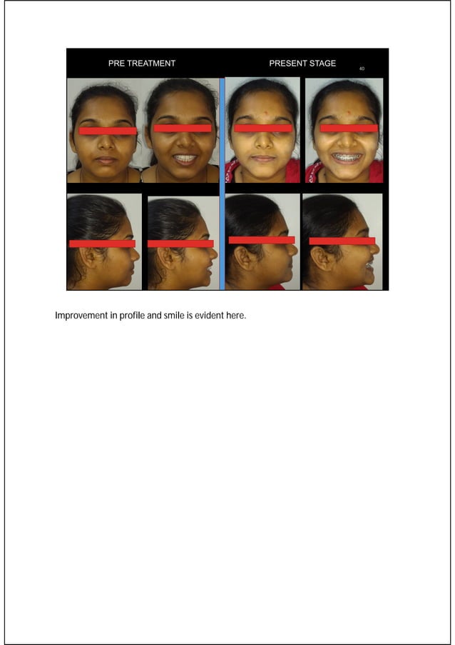 Orthodontic retraction biomechanics for space closure and distalization