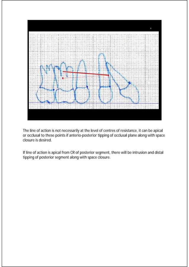 Orthodontic retraction biomechanics for space closure and distalization