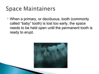  When a primary, or deciduous, tooth (commonly
called “baby” tooth) is lost too early, the space
needs to be held open until the permanent tooth is
ready to erupt.
 