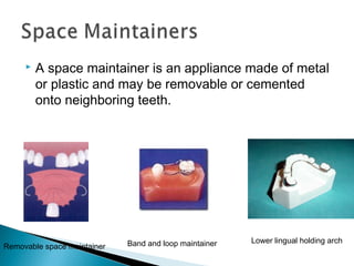  A space maintainer is an appliance made of metal
or plastic and may be removable or cemented
onto neighboring teeth.
Removable space maintainer Band and loop maintainer Lower lingual holding arch
 