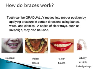 Teeth can be GRADUALLY moved into proper position by
applying pressure in certain directions using bands,
wires, and elastics. A series of clear trays, such as
Invisalign, may also be used.
standard
braces
lingual
braces
“Clear”
braces
virtually
invisible
Invisalign trays
 