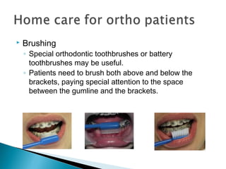  Brushing
◦ Special orthodontic toothbrushes or battery
toothbrushes may be useful.
◦ Patients need to brush both above and below the
brackets, paying special attention to the space
between the gumline and the brackets.
 