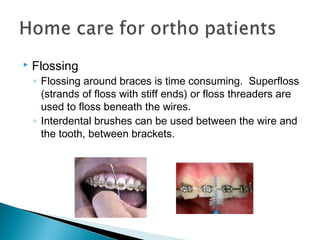  Flossing
◦ Flossing around braces is time consuming. Superfloss
(strands of floss with stiff ends) or floss threaders are
used to floss beneath the wires.
◦ Interdental brushes can be used between the wire and
the tooth, between brackets.
 