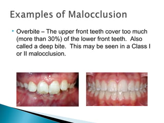  Overbite – The upper front teeth cover too much
(more than 30%) of the lower front teeth. Also
called a deep bite. This may be seen in a Class I
or II malocclusion.
 