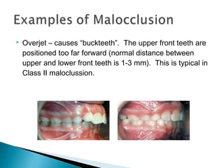  Overjet – causes “buckteeth”. The upper front teeth are
positioned too far forward (normal distance between
upper and lower front teeth is 1-3 mm). This is typical in
Class II maloclussion.
 