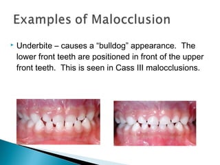  Underbite – causes a “bulldog” appearance. The
lower front teeth are positioned in front of the upper
front teeth. This is seen in Cass III malocclusions.
 