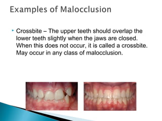  Crossbite – The upper teeth should overlap the
lower teeth slightly when the jaws are closed.
When this does not occur, it is called a crossbite.
May occur in any class of malocclusion.
 