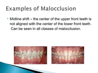  Midline shift – the center of the upper front teeth is
not aligned with the center of the lower front teeth.
Can be seen in all classes of malocclusion.
 