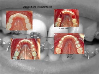 before
treatment
treatment
after
Crowded and irregular teeth
 