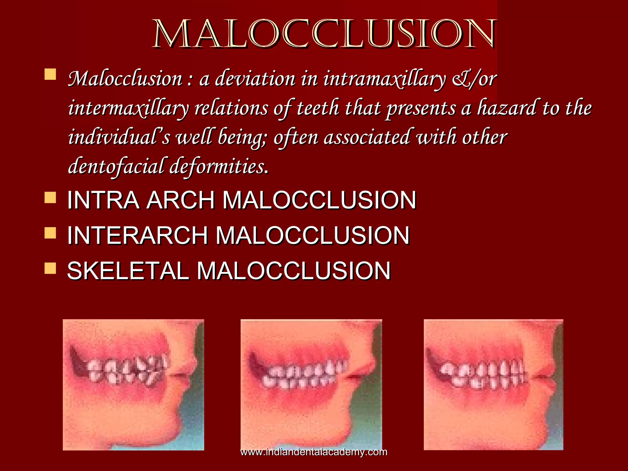 MALOCCLUSIONMALOCCLUSION
 Malocclusion : a deviation in intramaxillary &/orMalocclusion : a deviation in intramaxillary &/or
intermaxillary relations of teeth that presents a hazard to theintermaxillary relations of teeth that presents a hazard to the
individual’s well being; often associated with otherindividual’s well being; often associated with other
dentofacial deformitiesdentofacial deformities..
 INTRA ARCH MALOCCLUSIONINTRA ARCH MALOCCLUSION
 INTERARCH MALOCCLUSIONINTERARCH MALOCCLUSION
 SKELETAL MALOCCLUSIONSKELETAL MALOCCLUSION
www.indiandentalacademy.comwww.indiandentalacademy.com
 