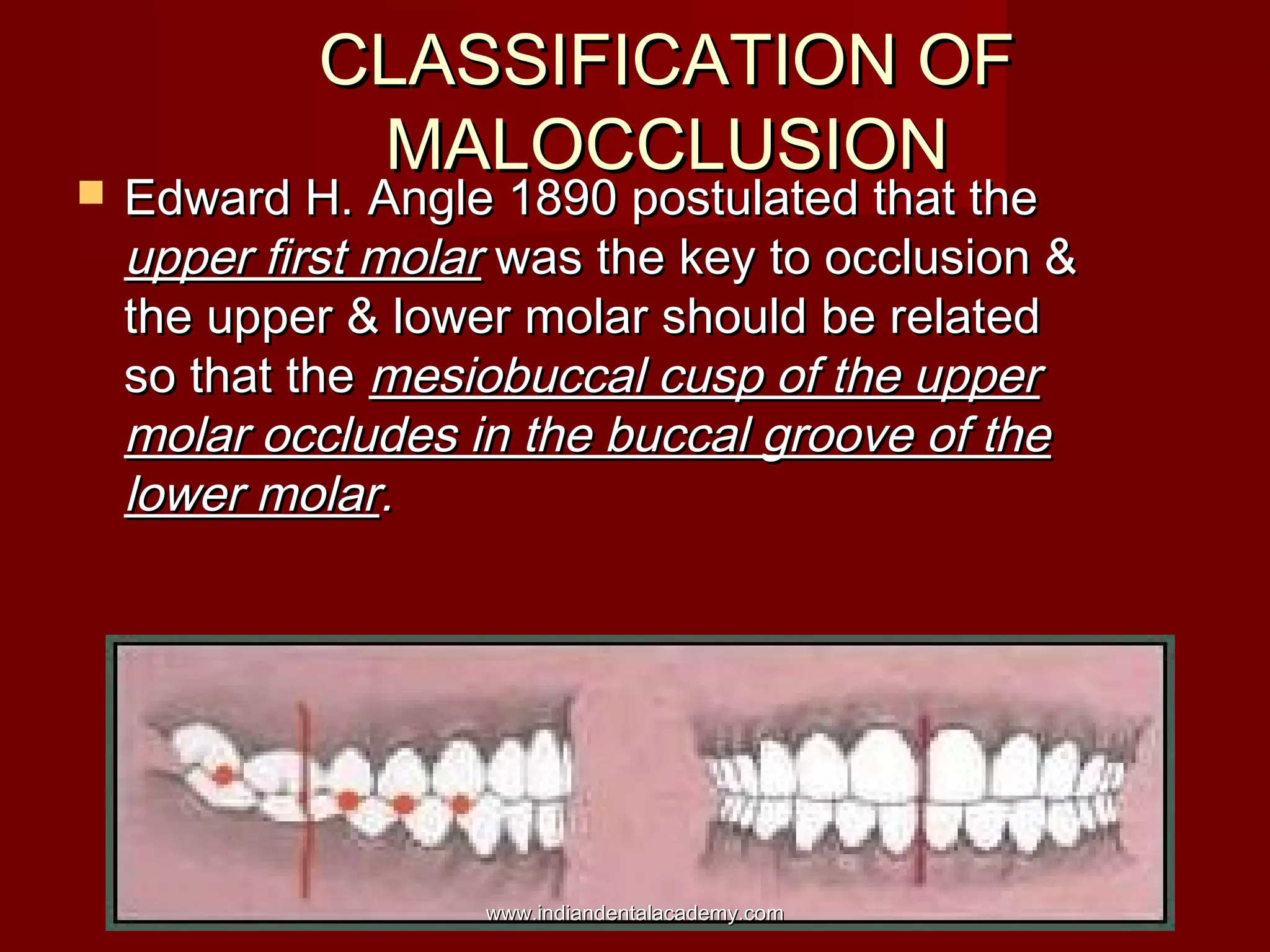 CLASSIFICATION OFCLASSIFICATION OF
MALOCCLUSIONMALOCCLUSION
 Edward H. Angle 1890 postulated that theEdward H. Angle 1890 postulated that the
upper first molarupper first molar was the key to occlusion &was the key to occlusion &
the upper & lower molar should be relatedthe upper & lower molar should be related
so that theso that the mesiobuccal cusp of the uppermesiobuccal cusp of the upper
molar occludes in the buccal groove of themolar occludes in the buccal groove of the
lower molarlower molar..
www.indiandentalacademy.comwww.indiandentalacademy.com
 