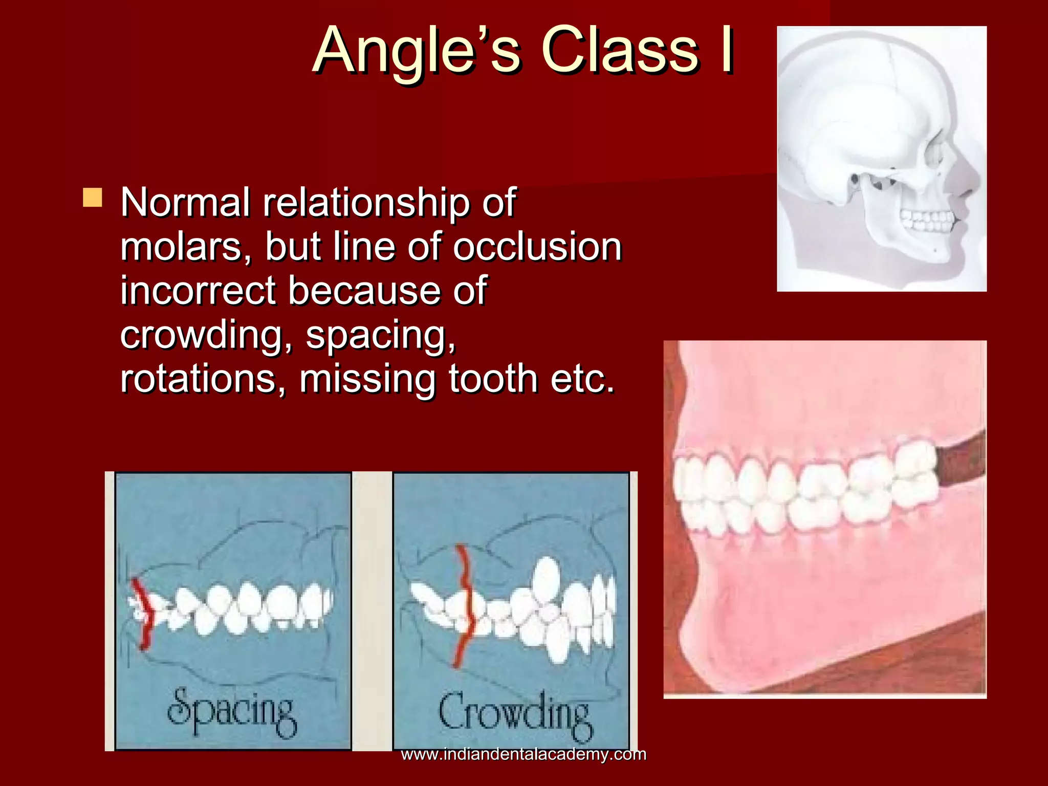 Angle’s Class IAngle’s Class I
 Normal relationship ofNormal relationship of
molars, but line of occlusionmolars, but line of occlusion
incorrect because ofincorrect because of
crowding, spacing,crowding, spacing,
rotations, missing tooth etc.rotations, missing tooth etc.
www.indiandentalacademy.comwww.indiandentalacademy.com
 