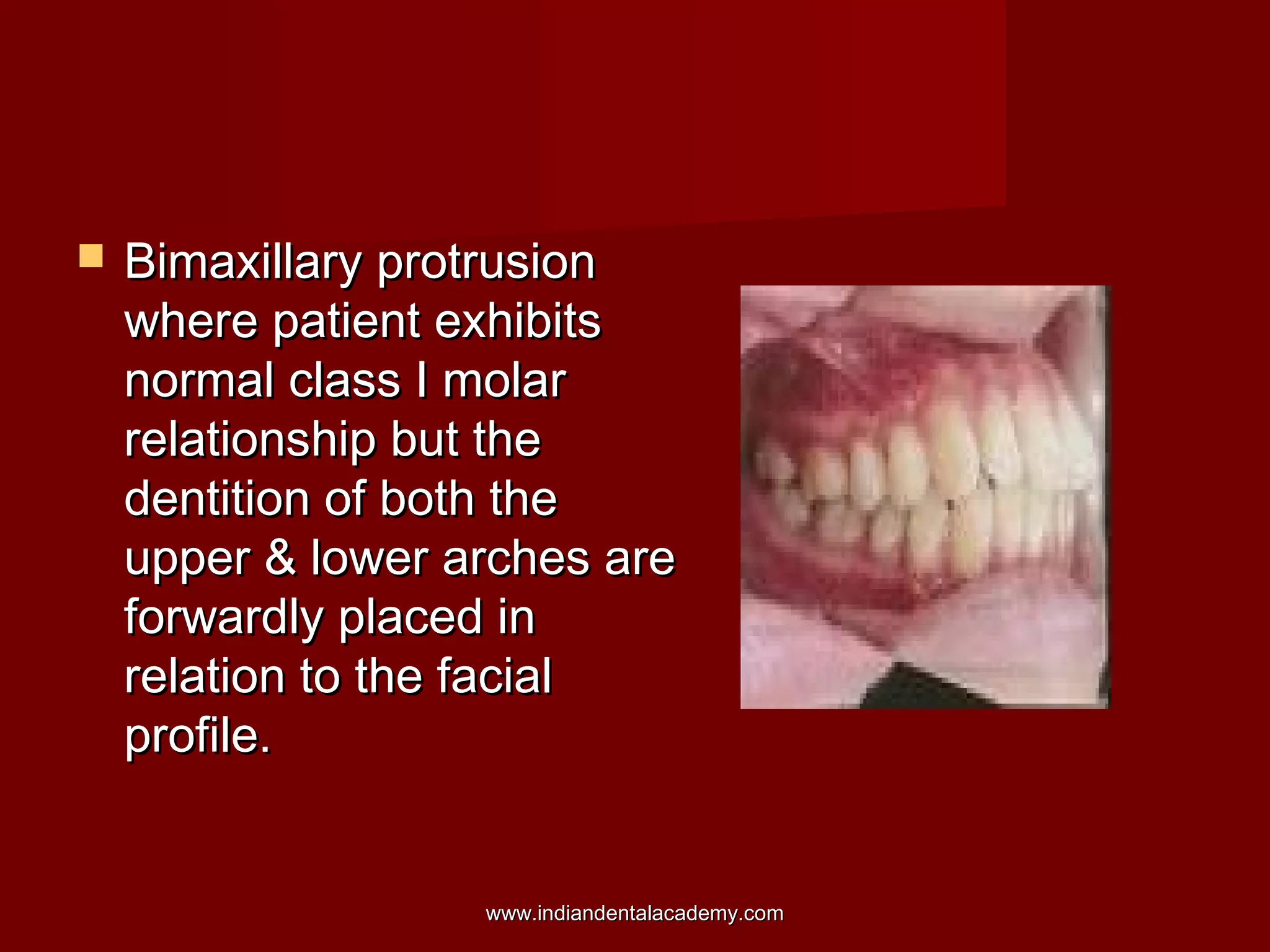  Bimaxillary protrusionBimaxillary protrusion
where patient exhibitswhere patient exhibits
normal class I molarnormal class I molar
relationship but therelationship but the
dentition of both thedentition of both the
upper & lower arches areupper & lower arches are
forwardly placed inforwardly placed in
relation to the facialrelation to the facial
profile.profile.
www.indiandentalacademy.comwww.indiandentalacademy.com
 