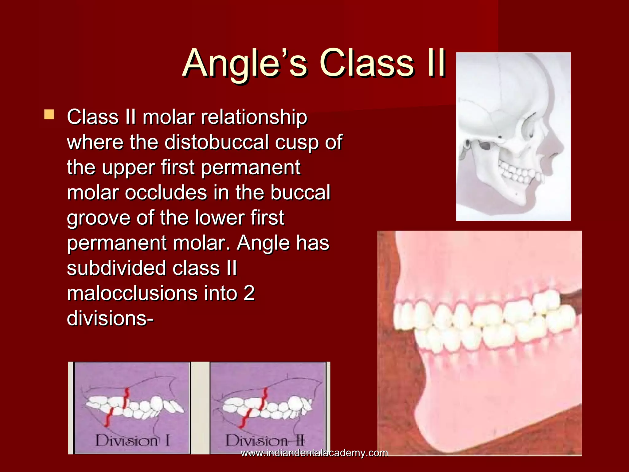 Angle’s Class IIAngle’s Class II
 Class II molar relationshipClass II molar relationship
where the distobuccal cusp ofwhere the distobuccal cusp of
the upper first permanentthe upper first permanent
molar occludes in the buccalmolar occludes in the buccal
groove of the lower firstgroove of the lower first
permanent molar. Angle haspermanent molar. Angle has
subdivided class IIsubdivided class II
malocclusions into 2malocclusions into 2
divisions-divisions-
www.indiandentalacademy.comwww.indiandentalacademy.com
 