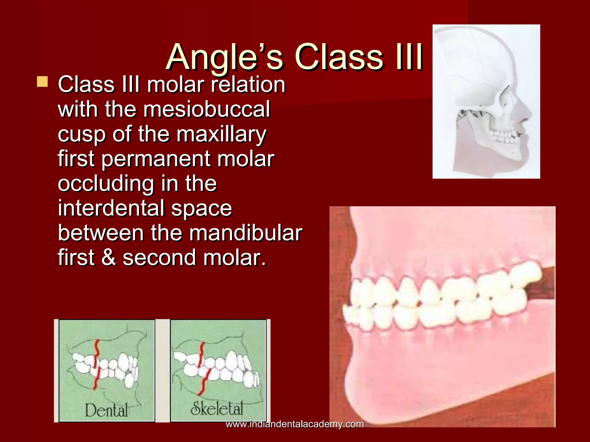 Angle’s Class IIIAngle’s Class III
 Class III molar relationClass III molar relation
with the mesiobuccalwith the mesiobuccal
cusp of the maxillarycusp of the maxillary
first permanent molarfirst permanent molar
occluding in theoccluding in the
interdental spaceinterdental space
between the mandibularbetween the mandibular
first & second molar.first & second molar.
www.indiandentalacademy.comwww.indiandentalacademy.com
 