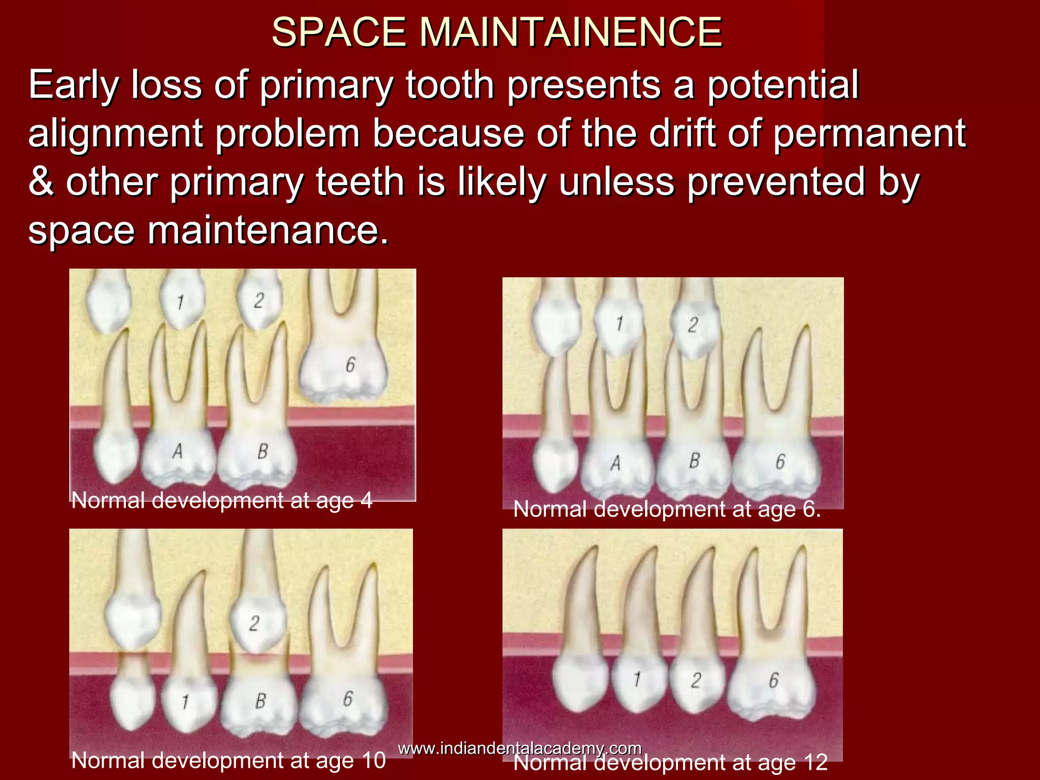 Normal development at age 4 Normal development at age 6.
Normal development at age 10 Normal development at age 12
SPACE MAINTAINENCESPACE MAINTAINENCE
Early loss of primary tooth presents a potentialEarly loss of primary tooth presents a potential
alignment problem because of the drift of permanentalignment problem because of the drift of permanent
& other primary teeth is likely unless prevented by& other primary teeth is likely unless prevented by
space maintenance.space maintenance.
www.indiandentalacademy.comwww.indiandentalacademy.com
 