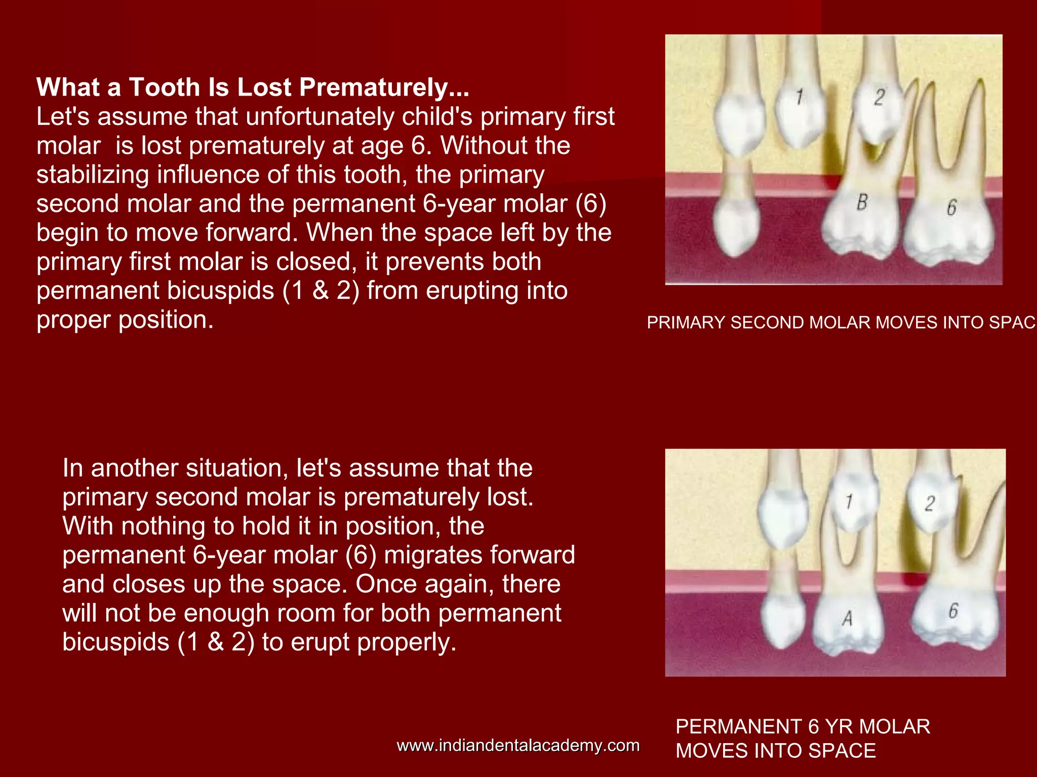 What a Tooth Is Lost Prematurely...
Let's assume that unfortunately child's primary first
molar is lost prematurely at age 6. Without the
stabilizing influence of this tooth, the primary
second molar and the permanent 6-year molar (6)
begin to move forward. When the space left by the
primary first molar is closed, it prevents both
permanent bicuspids (1 & 2) from erupting into
proper position.
In another situation, let's assume that the
primary second molar is prematurely lost.
With nothing to hold it in position, the
permanent 6-year molar (6) migrates forward
and closes up the space. Once again, there
will not be enough room for both permanent
bicuspids (1 & 2) to erupt properly.
PRIMARY SECOND MOLAR MOVES INTO SPACE
PERMANENT 6 YR MOLAR
MOVES INTO SPACEwww.indiandentalacademy.comwww.indiandentalacademy.com
 
