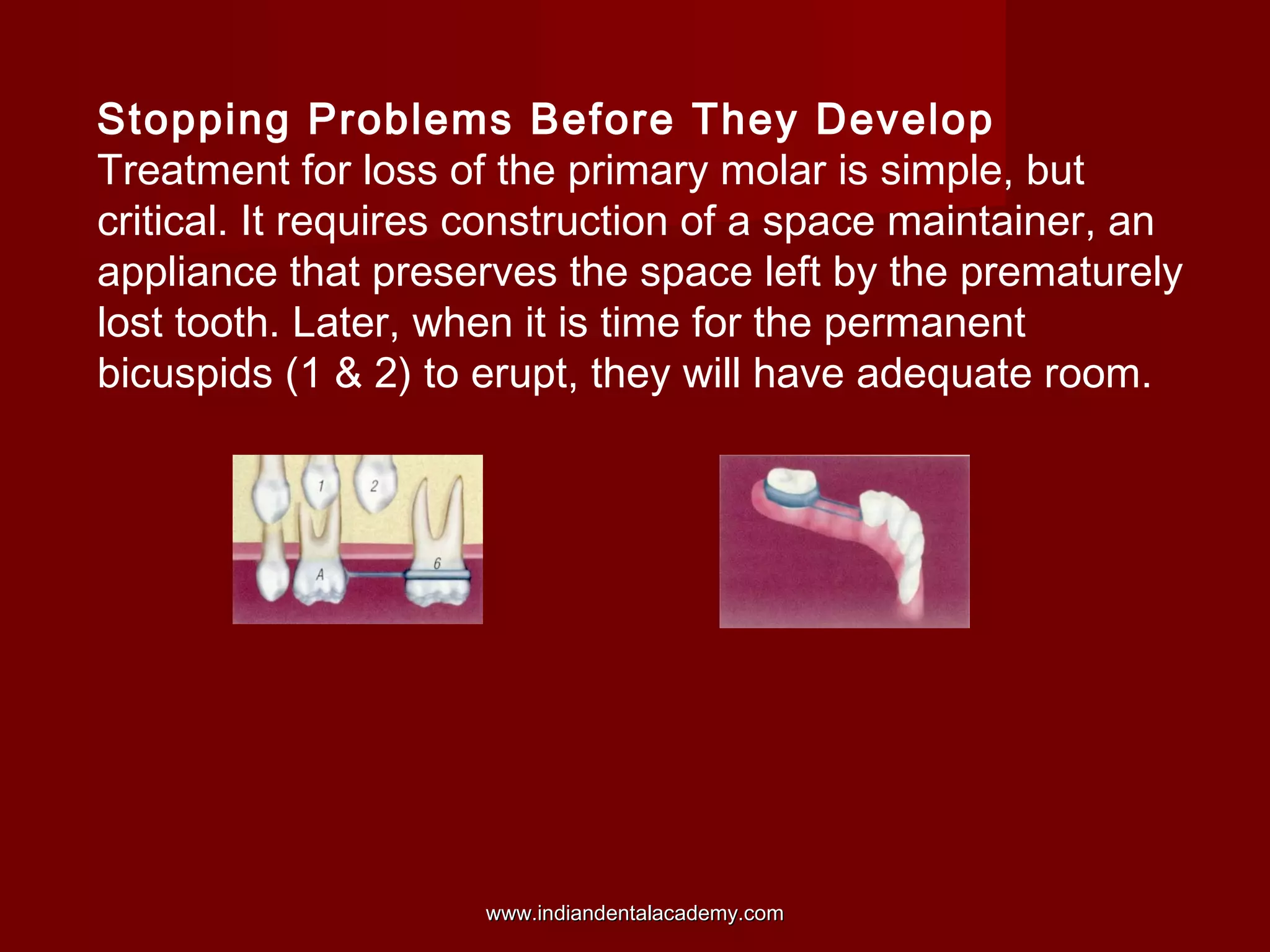 Stopping Problems Before They Develop
Treatment for loss of the primary molar is simple, but
critical. It requires construction of a space maintainer, an
appliance that preserves the space left by the prematurely
lost tooth. Later, when it is time for the permanent
bicuspids (1 & 2) to erupt, they will have adequate room.
www.indiandentalacademy.comwww.indiandentalacademy.com
 