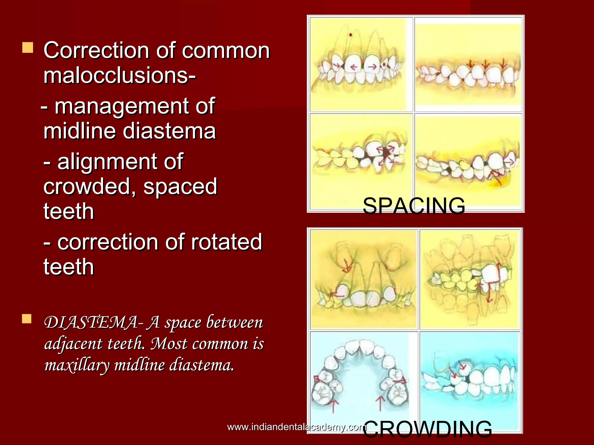  Correction of commonCorrection of common
malocclusions-malocclusions-
- management of- management of
midline diastemamidline diastema
- alignment of- alignment of
crowded, spacedcrowded, spaced
teethteeth
- correction of rotated- correction of rotated
teethteeth
 DIASTEMA- A space betweenDIASTEMA- A space between
adjacent teeth. Most common isadjacent teeth. Most common is
maxillary midline diastema.maxillary midline diastema.
SPACING
CROWDINGwww.indiandentalacademy.comwww.indiandentalacademy.com
 