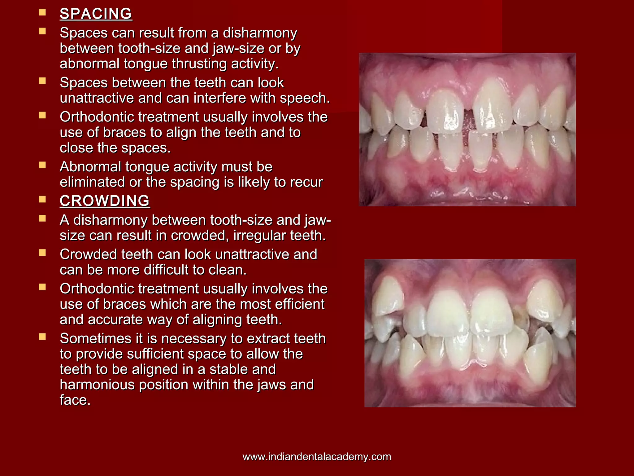  SPACINGSPACING
 Spaces can result from a disharmonySpaces can result from a disharmony
between tooth-size and jaw-size or bybetween tooth-size and jaw-size or by
abnormal tongue thrusting activity.abnormal tongue thrusting activity.
 Spaces between the teeth can lookSpaces between the teeth can look
unattractive and can interfere with speech.unattractive and can interfere with speech.
 Orthodontic treatment usually involves theOrthodontic treatment usually involves the
use of braces to align the teeth and touse of braces to align the teeth and to
close the spaces.close the spaces.
 Abnormal tongue activity must beAbnormal tongue activity must be
eliminated or the spacing is likely to recureliminated or the spacing is likely to recur
 CROWDINGCROWDING
 A disharmony between tooth-size and jaw-A disharmony between tooth-size and jaw-
size can result in crowded, irregular teeth.size can result in crowded, irregular teeth.
 Crowded teeth can look unattractive andCrowded teeth can look unattractive and
can be more difficult to clean.can be more difficult to clean.
 Orthodontic treatment usually involves theOrthodontic treatment usually involves the
use of braces which are the most efficientuse of braces which are the most efficient
and accurate way of aligning teeth.and accurate way of aligning teeth.
 Sometimes it is necessary to extract teethSometimes it is necessary to extract teeth
to provide sufficient space to allow theto provide sufficient space to allow the
teeth to be aligned in a stable andteeth to be aligned in a stable and
harmonious position within the jaws andharmonious position within the jaws and
face.face.
www.indiandentalacademy.comwww.indiandentalacademy.com
 