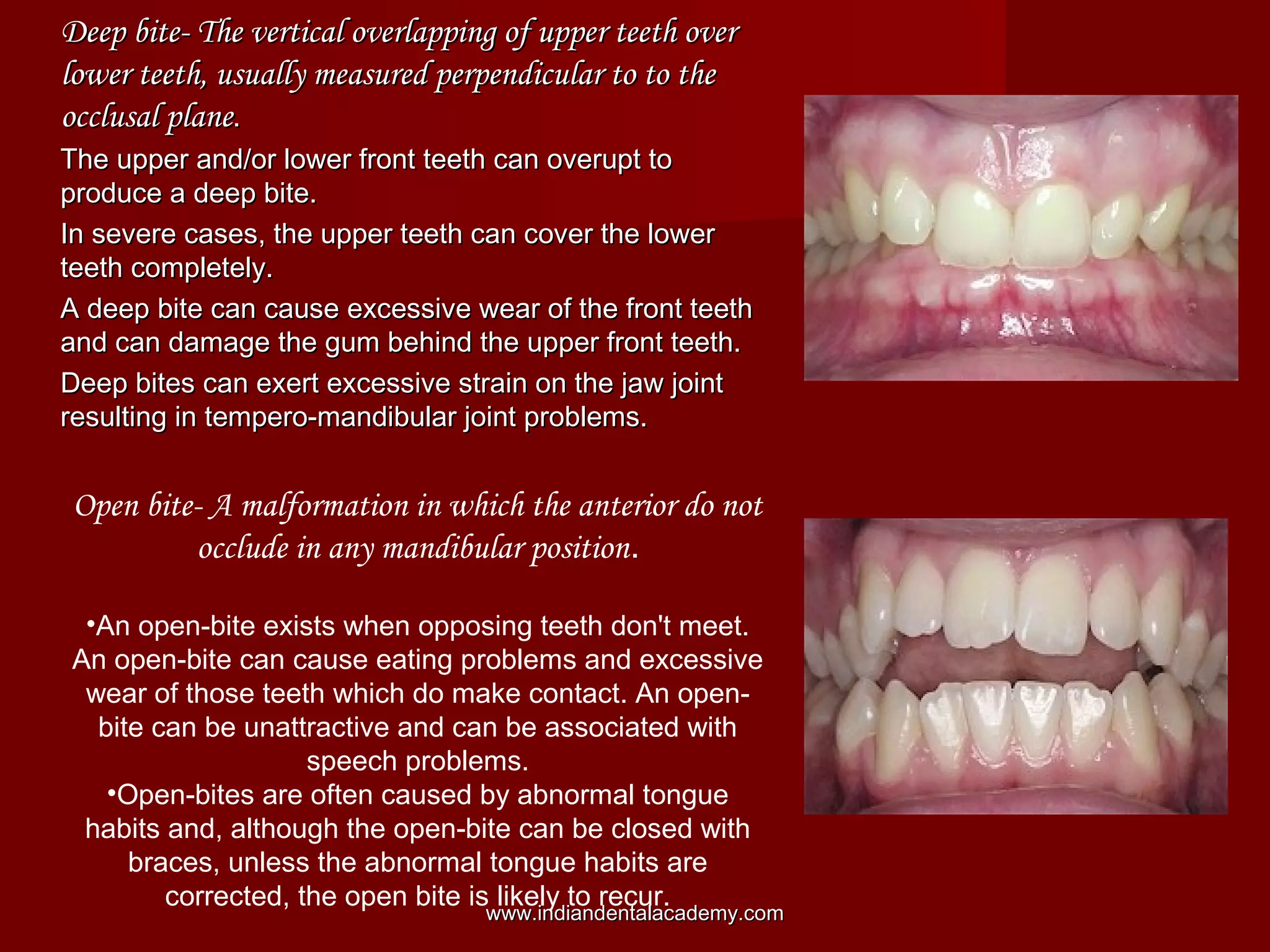 Deep bite- The vertical overlapping of upper teeth overDeep bite- The vertical overlapping of upper teeth over
lower teeth, usually measured perpendicular to to thelower teeth, usually measured perpendicular to to the
occlusal planeocclusal plane..
The upper and/or lower front teeth can overupt toThe upper and/or lower front teeth can overupt to
produce a deep bite.produce a deep bite.
In severe cases, the upper teeth can cover the lowerIn severe cases, the upper teeth can cover the lower
teeth completely.teeth completely.
A deep bite can cause excessive wear of the front teethA deep bite can cause excessive wear of the front teeth
and can damage the gum behind the upper front teeth.and can damage the gum behind the upper front teeth.
Deep bites can exert excessive strain on the jaw jointDeep bites can exert excessive strain on the jaw joint
resulting in tempero-mandibular joint problems.resulting in tempero-mandibular joint problems.
  
Open bite- A malformation in which the anterior do not
occlude in any mandibular position.
•An open-bite exists when opposing teeth don't meet.
An open-bite can cause eating problems and excessive
wear of those teeth which do make contact. An open-
bite can be unattractive and can be associated with
speech problems.
•Open-bites are often caused by abnormal tongue
habits and, although the open-bite can be closed with
braces, unless the abnormal tongue habits are
corrected, the open bite is likely to recur.
www.indiandentalacademy.comwww.indiandentalacademy.com
 