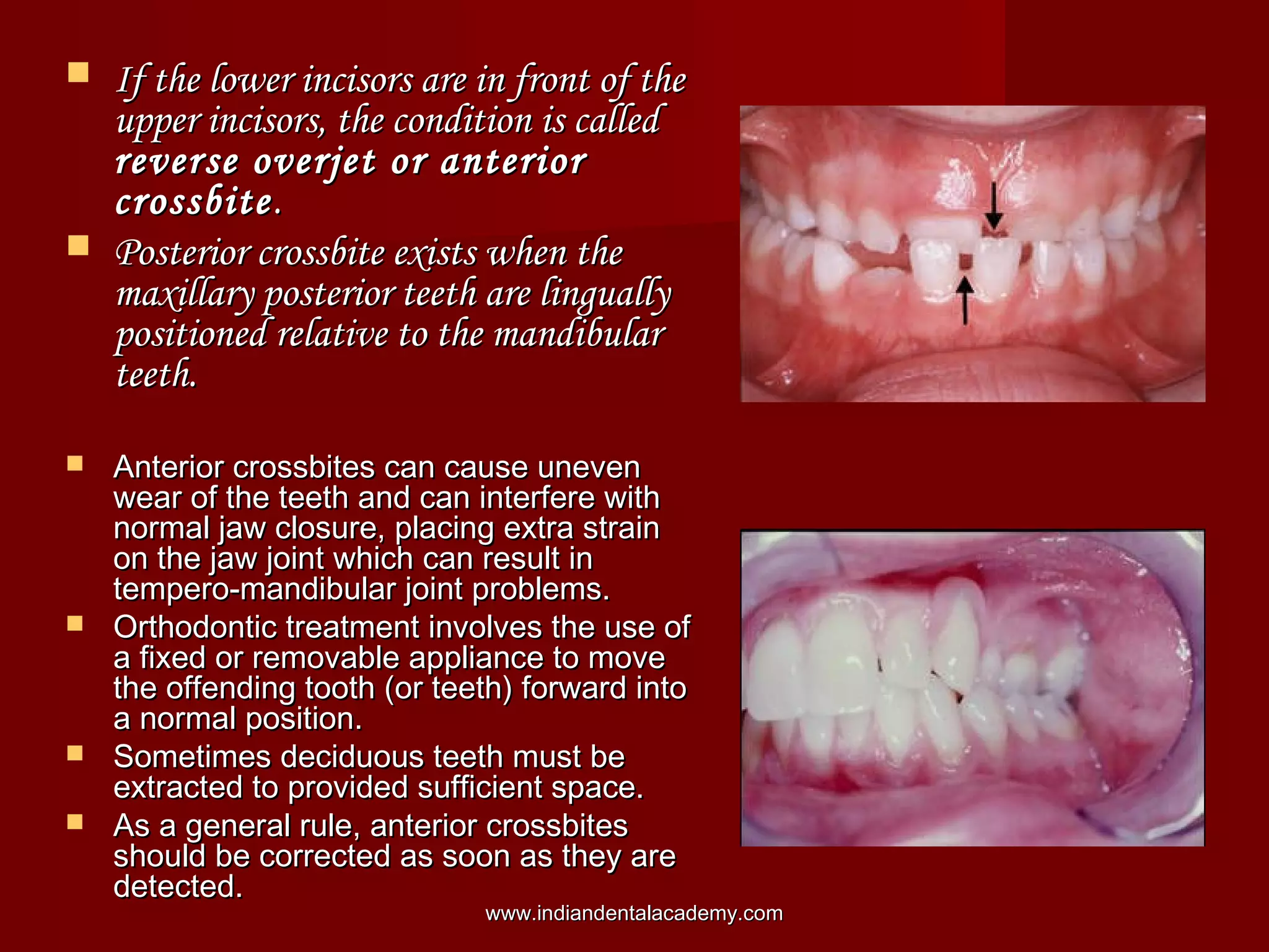  If the lower incisors are in front of theIf the lower incisors are in front of the
upper incisors, the condition is calledupper incisors, the condition is called
reverse overjet or anteriorreverse overjet or anterior
crossbitecrossbite..
 Posterior crossbite exists when thePosterior crossbite exists when the
maxillary posterior teeth are linguallymaxillary posterior teeth are lingually
positioned relative to the mandibularpositioned relative to the mandibular
teeth.teeth.
 Anterior crossbites can cause unevenAnterior crossbites can cause uneven
wear of the teeth and can interfere withwear of the teeth and can interfere with
normal jaw closure, placing extra strainnormal jaw closure, placing extra strain
on the jaw joint which can result inon the jaw joint which can result in
tempero-mandibular joint problems.tempero-mandibular joint problems.
 Orthodontic treatment involves the use ofOrthodontic treatment involves the use of
a fixed or removable appliance to movea fixed or removable appliance to move
the offending tooth (or teeth) forward intothe offending tooth (or teeth) forward into
a normal position.a normal position.
 Sometimes deciduous teeth must beSometimes deciduous teeth must be
extracted to provided sufficient space.extracted to provided sufficient space.
 As a general rule, anterior crossbitesAs a general rule, anterior crossbites
should be corrected as soon as they areshould be corrected as soon as they are
detected.detected.
www.indiandentalacademy.comwww.indiandentalacademy.com
 