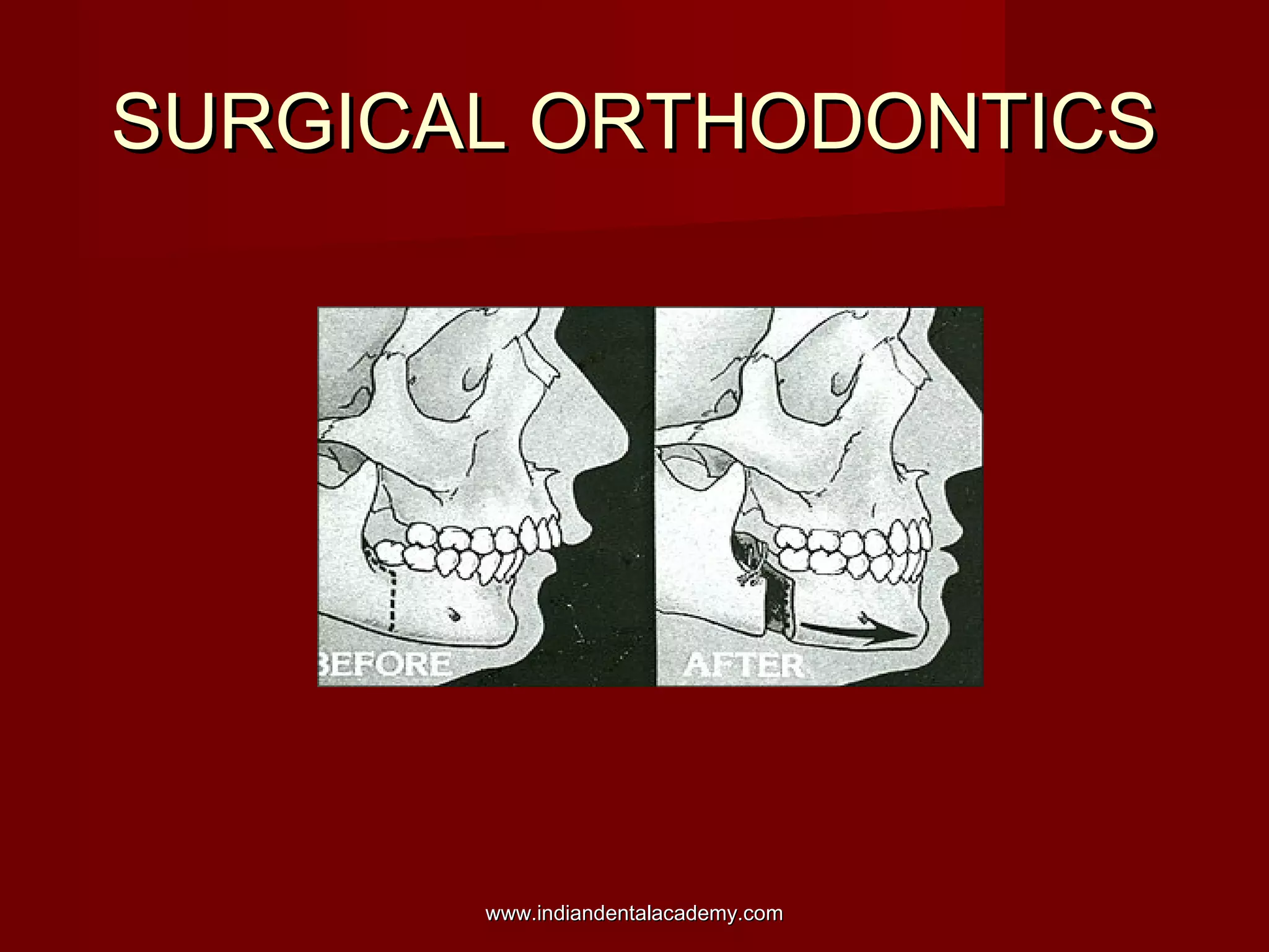 SURGICAL ORTHODONTICSSURGICAL ORTHODONTICS
www.indiandentalacademy.comwww.indiandentalacademy.com
 