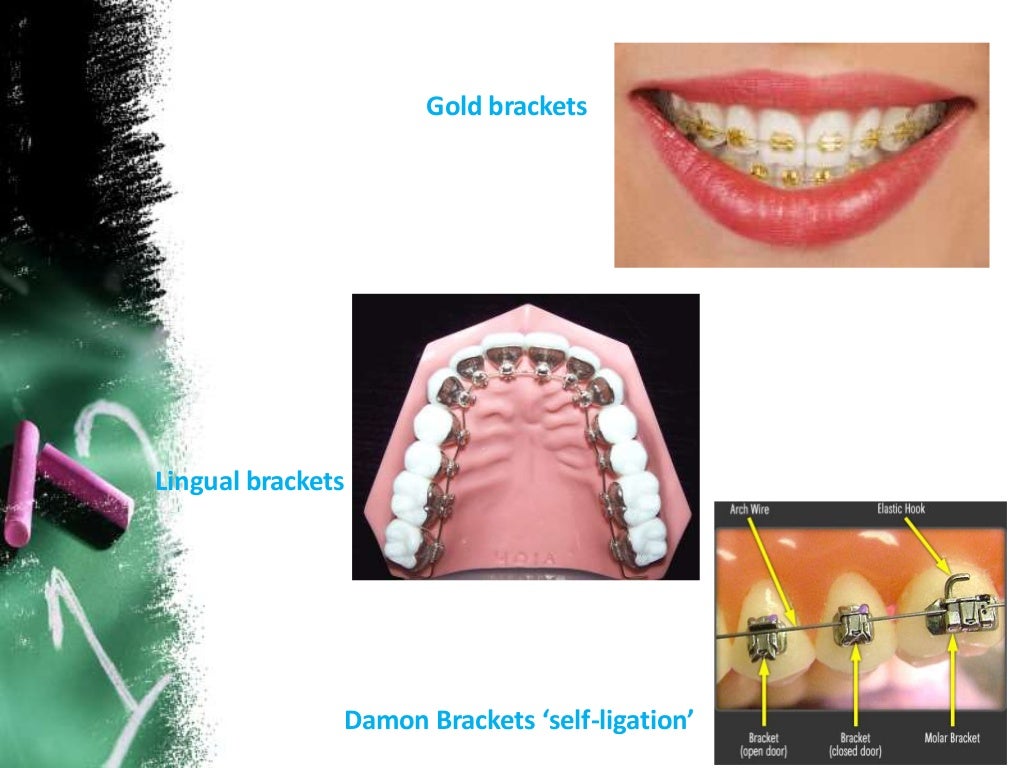 Orthodontics brackets removal