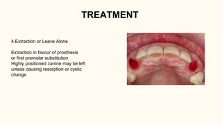 Prosthesis Extraction Drive Comprehensive Management of Impacted Canines in Orthodontics | PDF