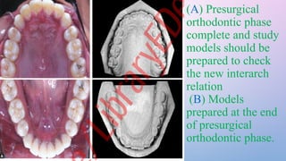 Interarch Relation Orthodontics for Orthognathic surgery.pptx
