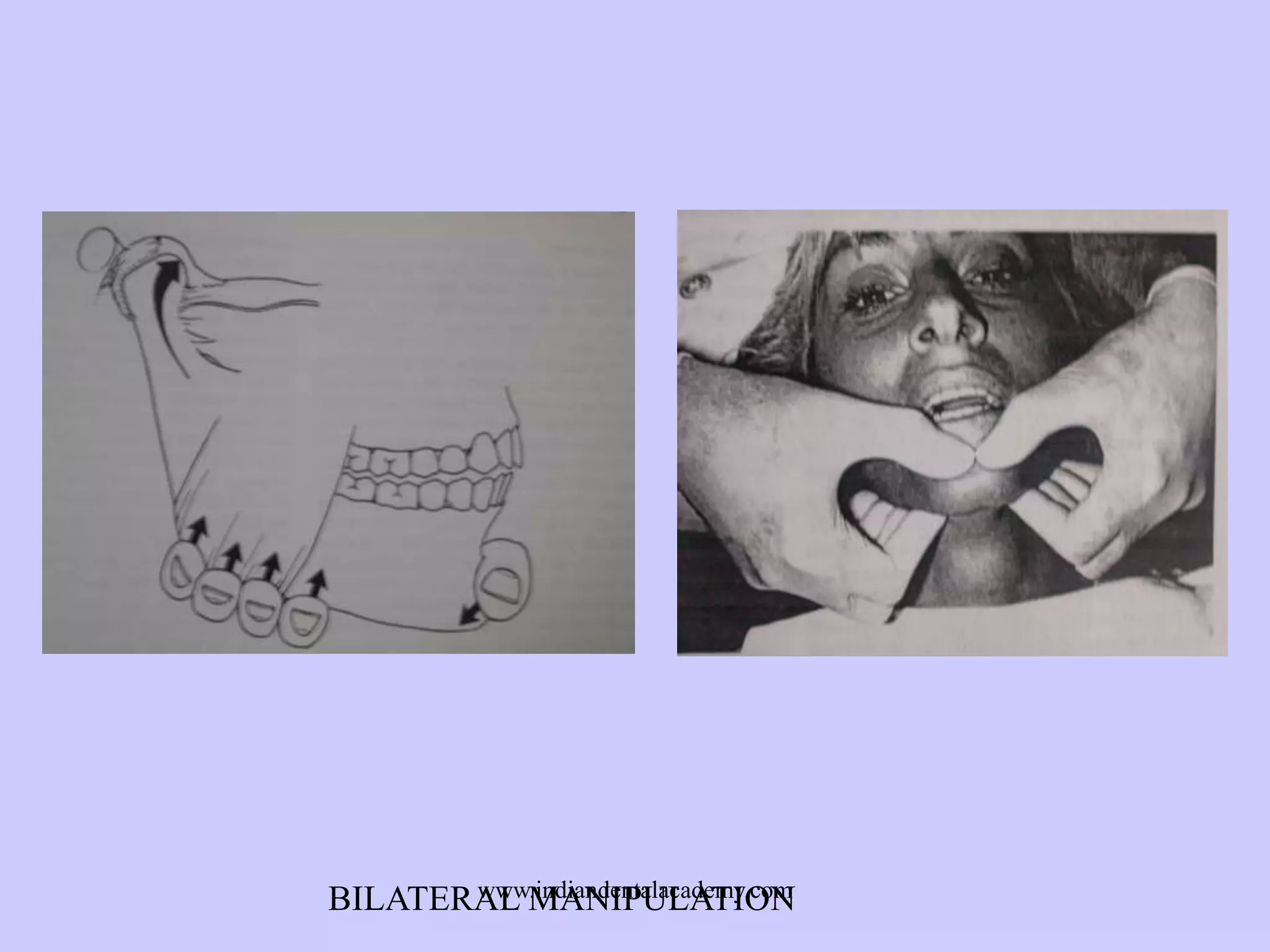 www.indiandentalacademy.com
BILATERAL MANIPULATION

 