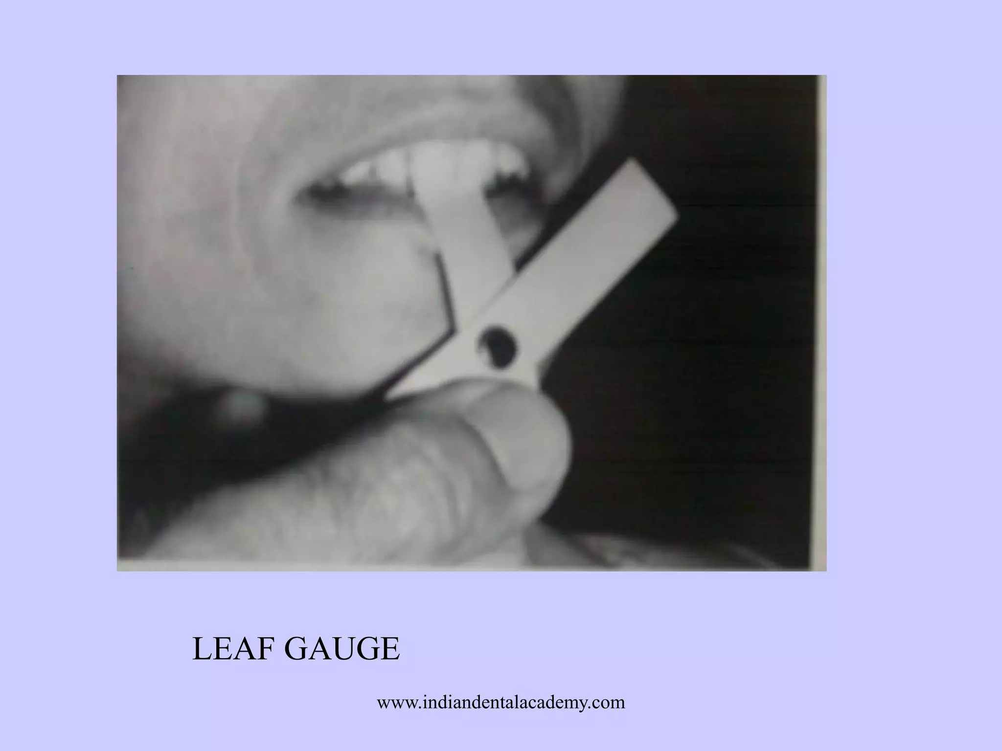 LEAF GAUGE
www.indiandentalacademy.com

 