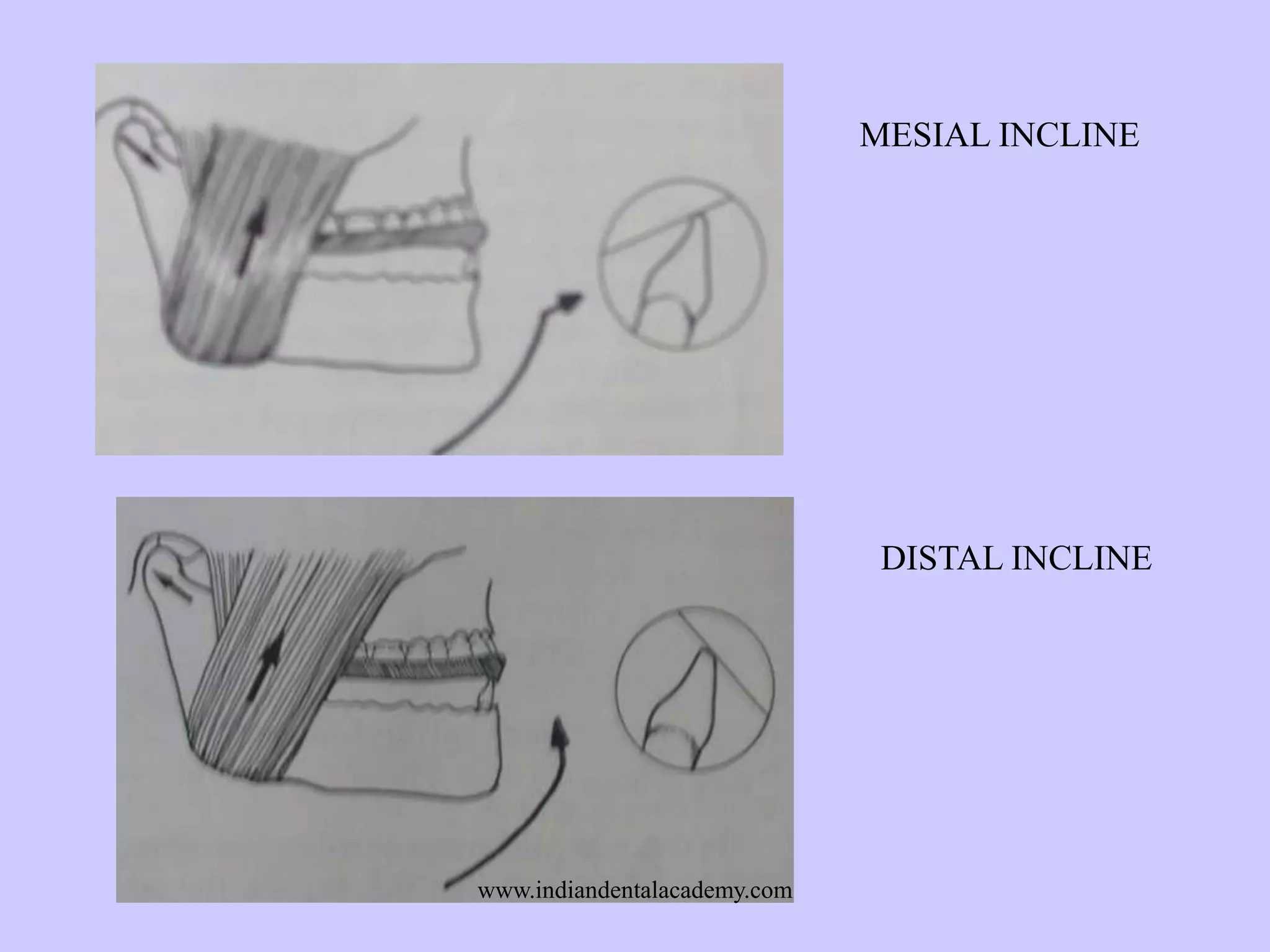 MESIAL INCLINE

DISTAL INCLINE

www.indiandentalacademy.com

 