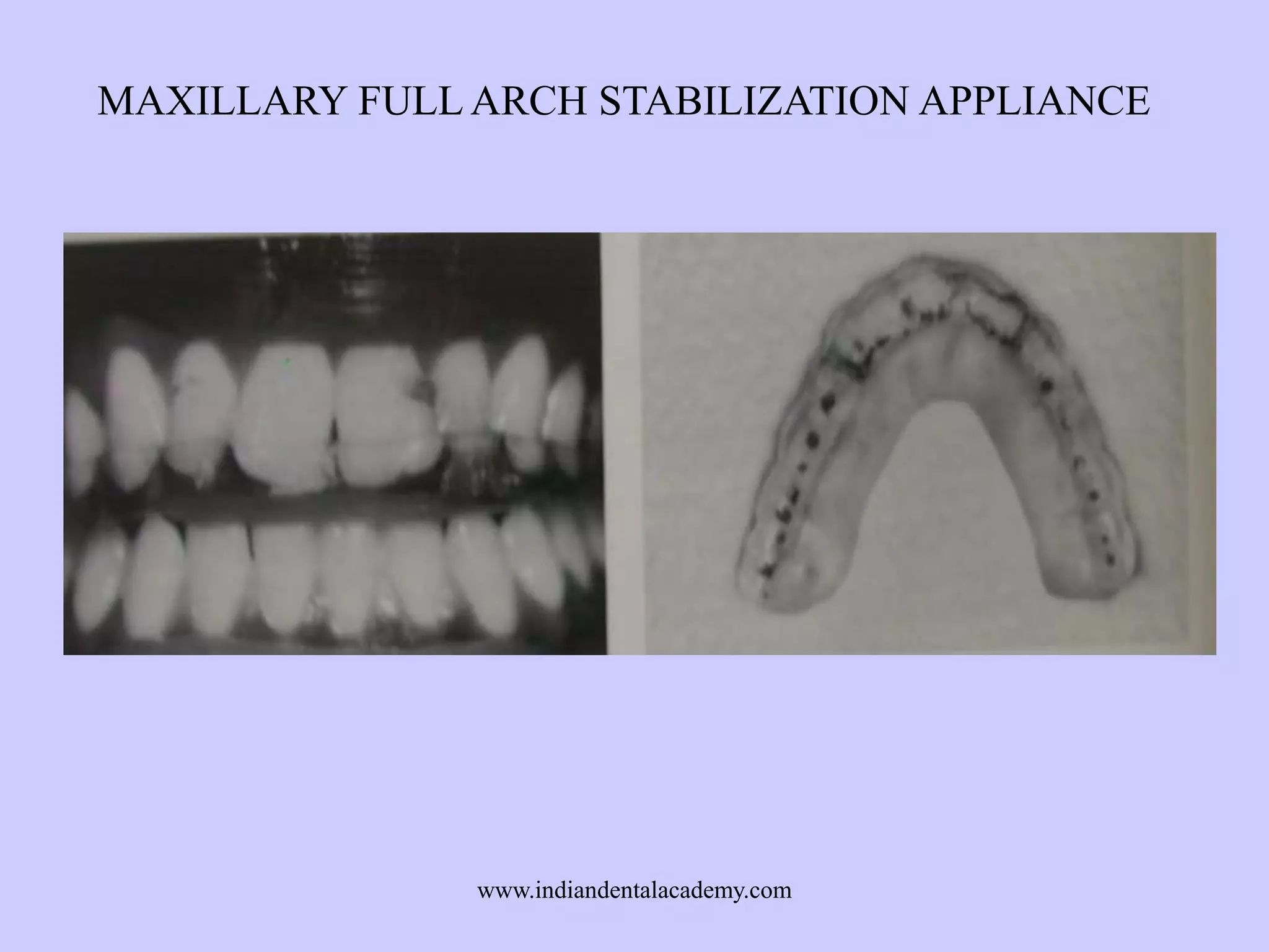 MAXILLARY FULL ARCH STABILIZATION APPLIANCE

www.indiandentalacademy.com

 