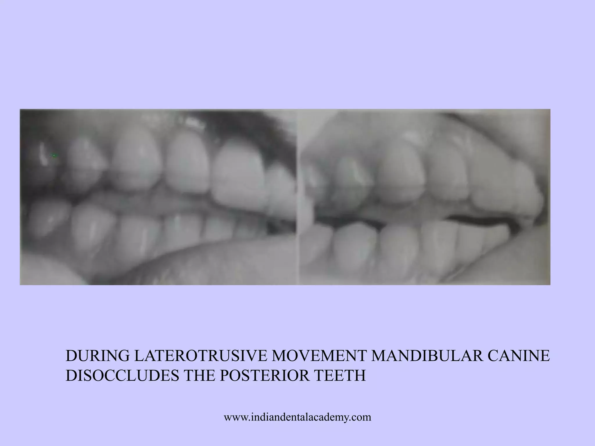 DURING LATEROTRUSIVE MOVEMENT MANDIBULAR CANINE
DISOCCLUDES THE POSTERIOR TEETH
www.indiandentalacademy.com

 
