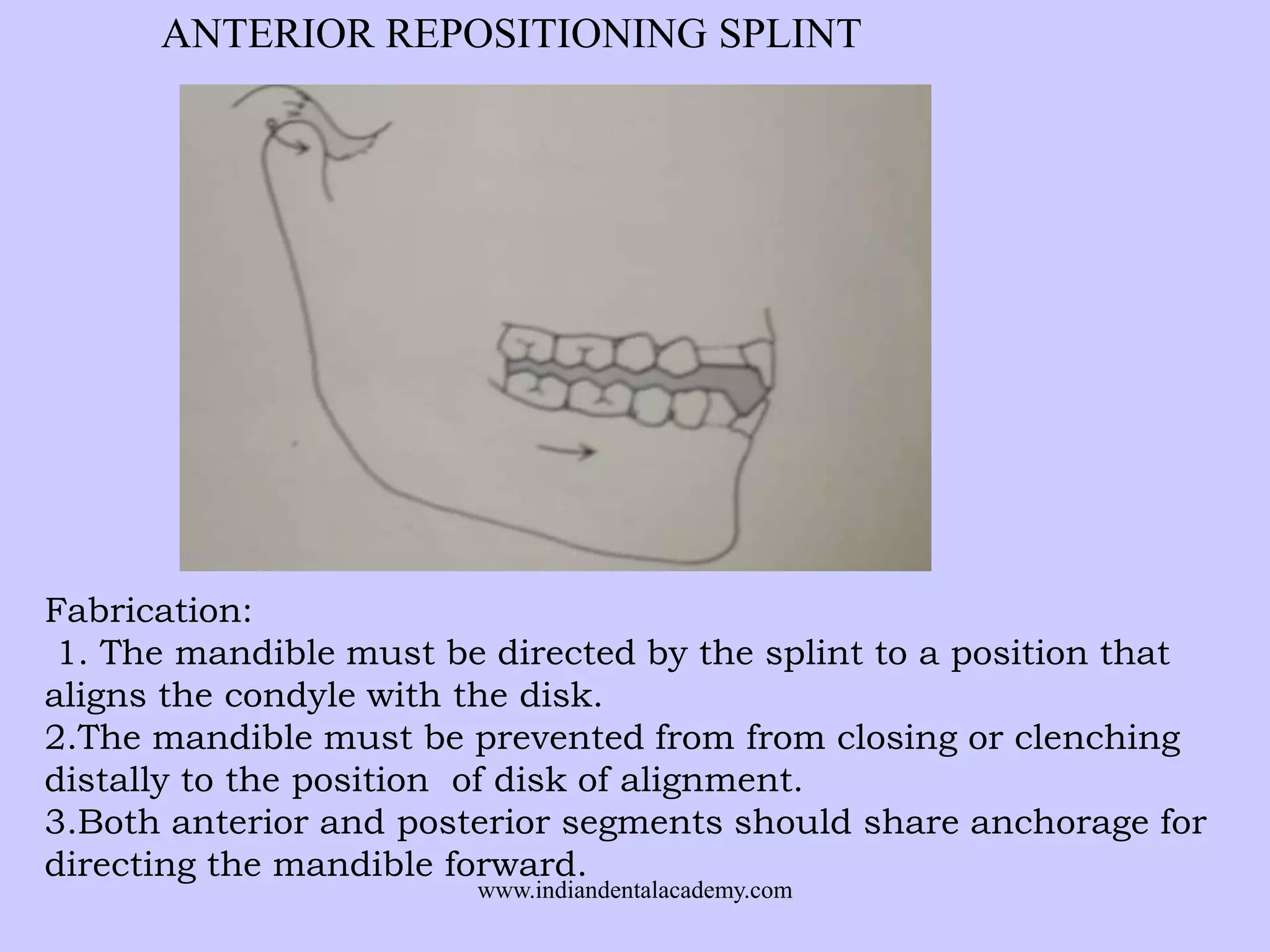 ANTERIOR REPOSITIONING SPLINT

Fabrication:
1. The mandible must be directed by the splint to a position that
aligns the condyle with the disk.
2.The mandible must be prevented from from closing or clenching
distally to the position of disk of alignment.
3.Both anterior and posterior segments should share anchorage for
directing the mandible forward.
www.indiandentalacademy.com

 