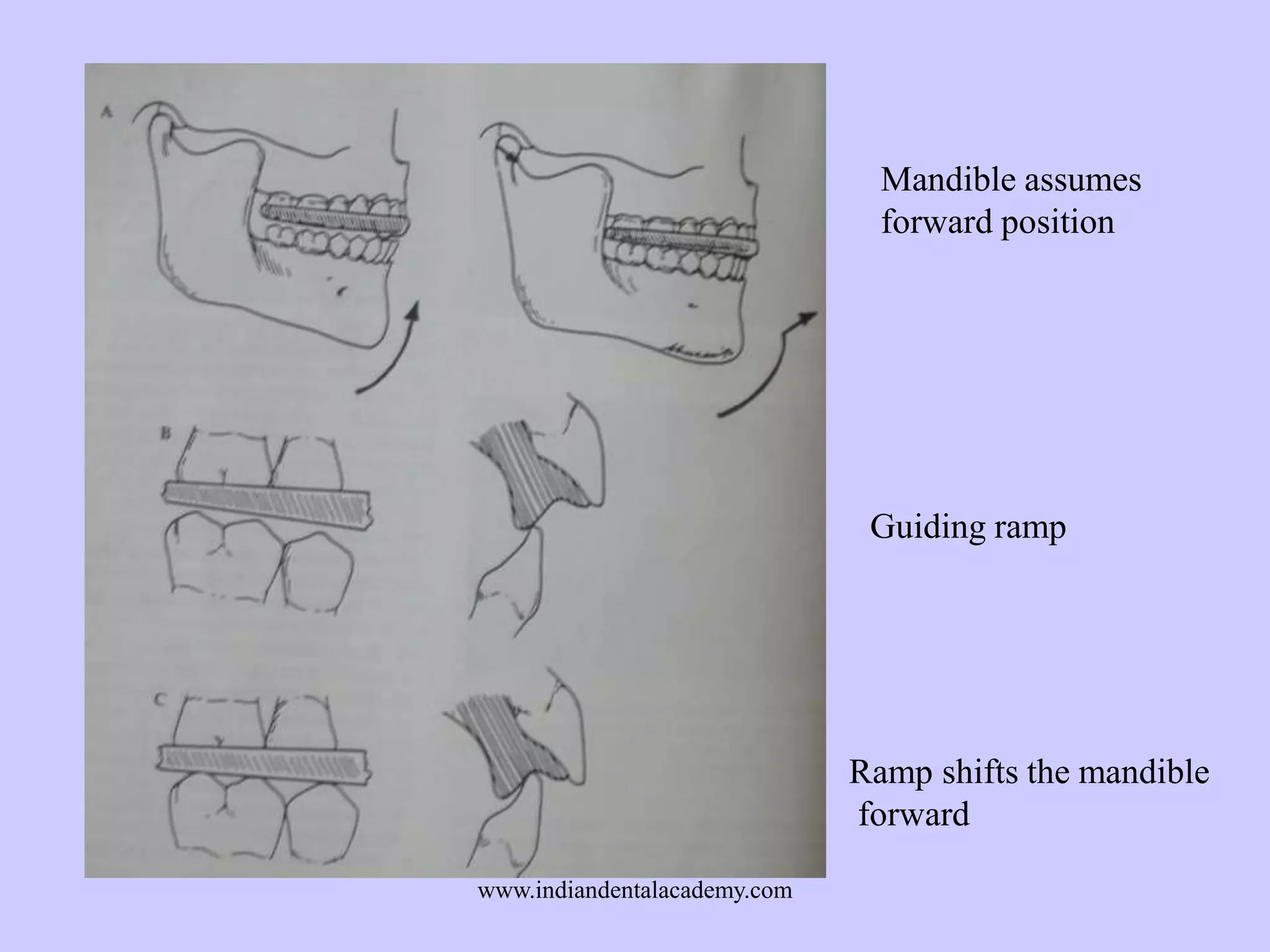 Mandible assumes
forward position

Guiding ramp

Ramp shifts the mandible
forward
www.indiandentalacademy.com

 