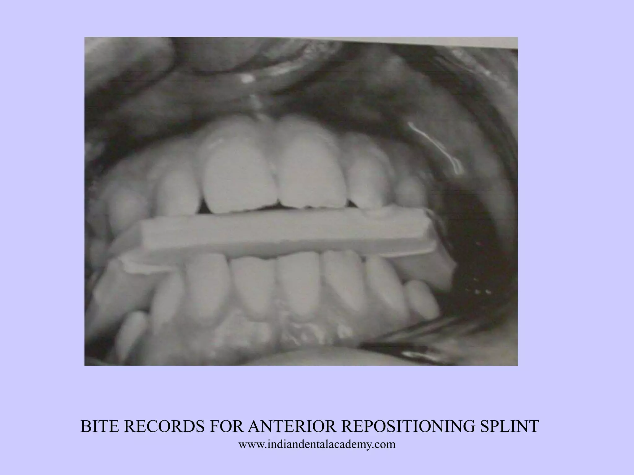 BITE RECORDS FOR ANTERIOR REPOSITIONING SPLINT
www.indiandentalacademy.com

 