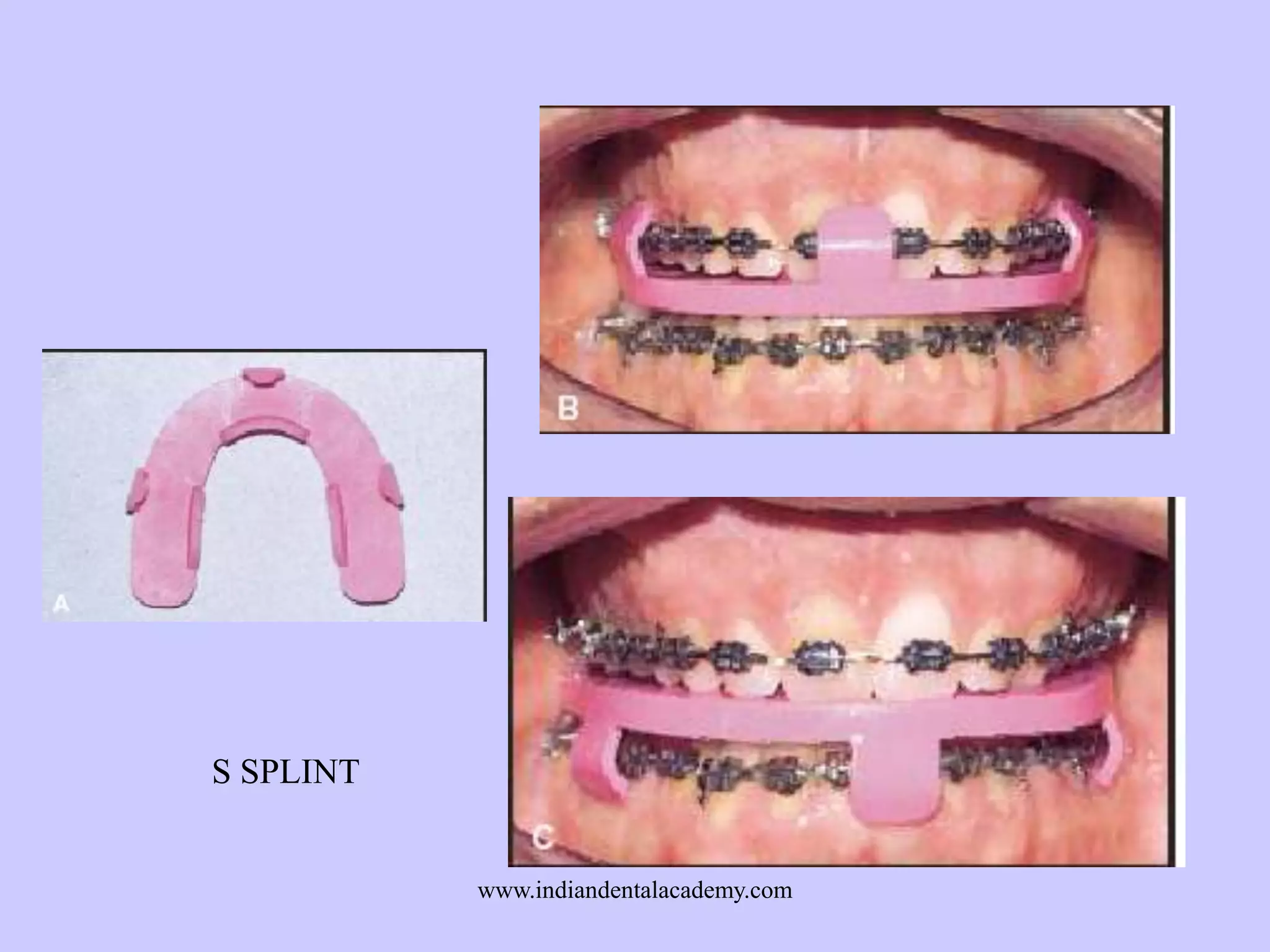 S SPLINT

www.indiandentalacademy.com

 