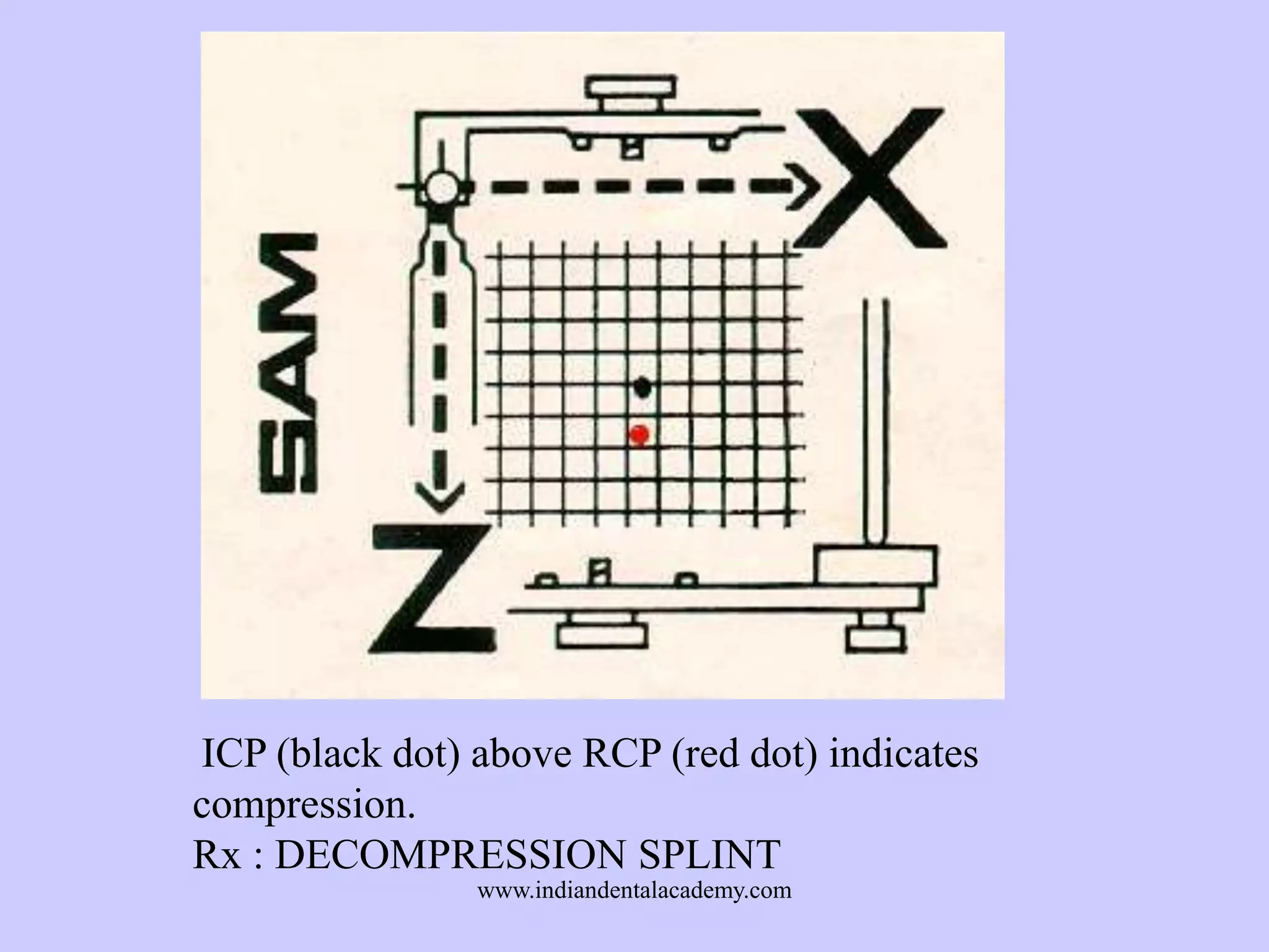 ICP (black dot) above RCP (red dot) indicates
compression.
Rx : DECOMPRESSION SPLINT
www.indiandentalacademy.com

 