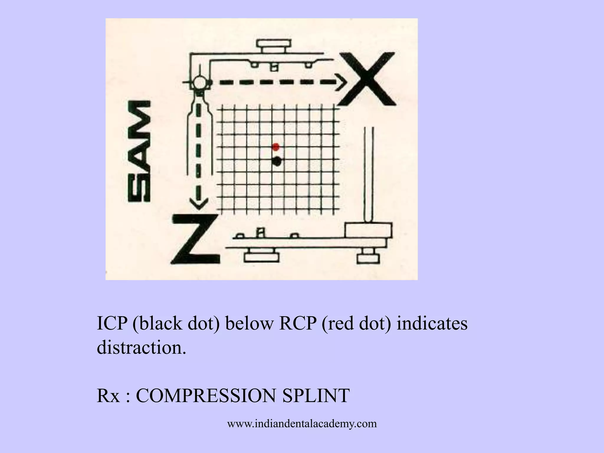 ICP (black dot) below RCP (red dot) indicates
distraction.
Rx : COMPRESSION SPLINT
www.indiandentalacademy.com

 