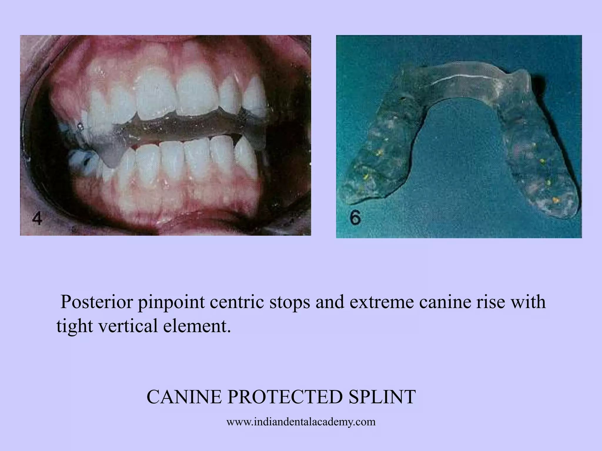 Posterior pinpoint centric stops and extreme canine rise with
tight vertical element.

CANINE PROTECTED SPLINT
www.indiandentalacademy.com

 