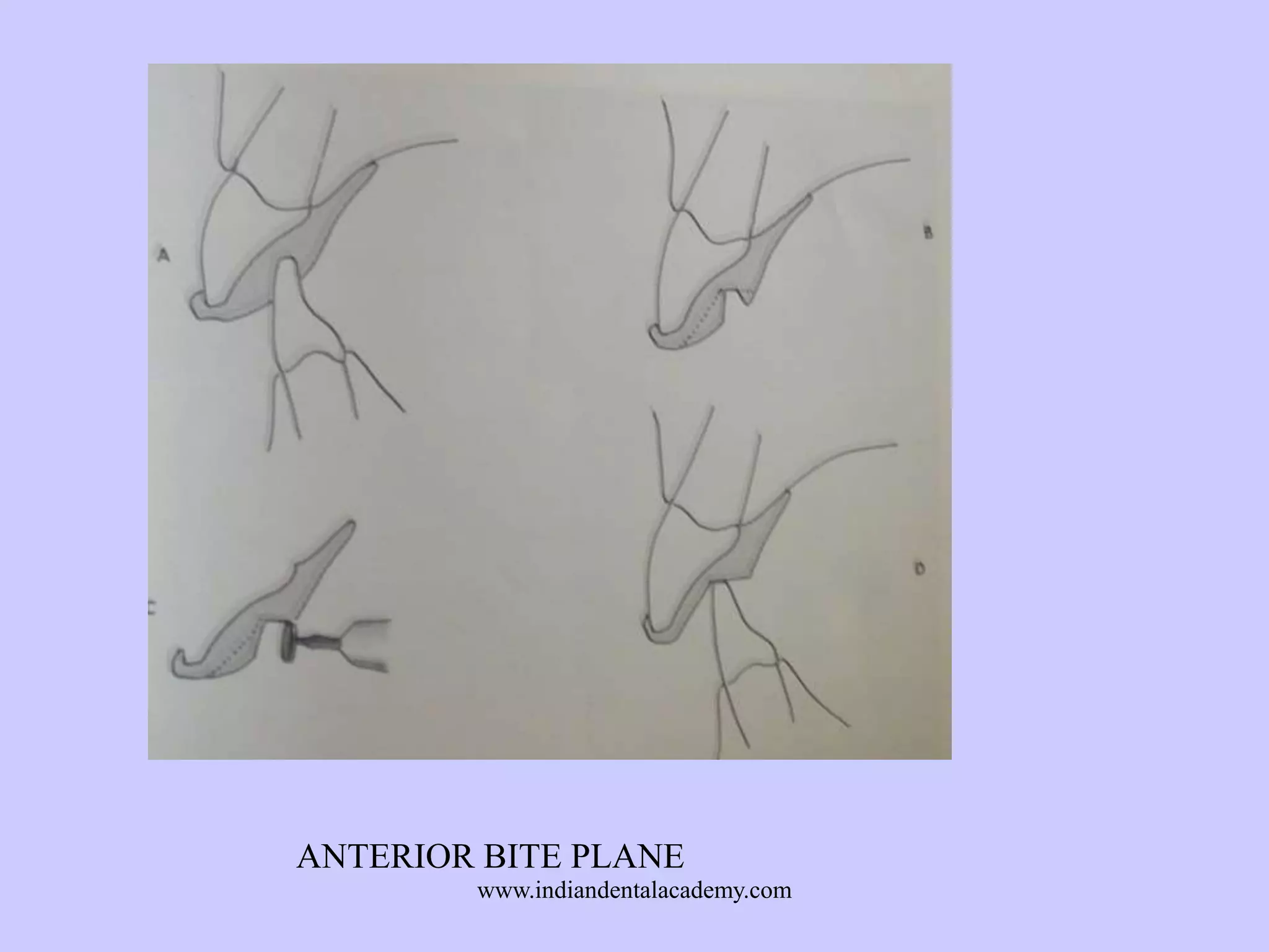 ANTERIOR BITE PLANE
www.indiandentalacademy.com

 