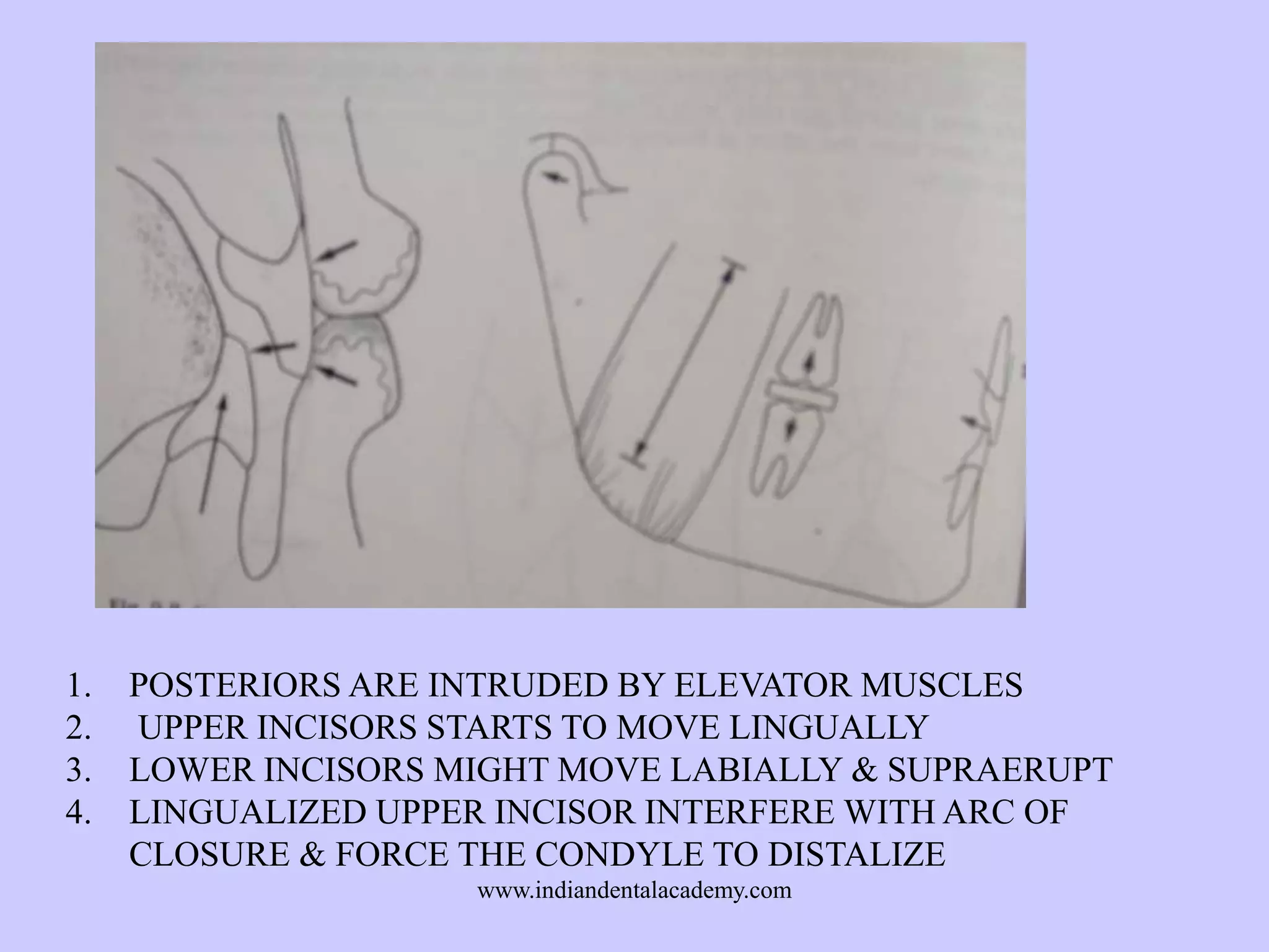 1.
2.
3.
4.

POSTERIORS ARE INTRUDED BY ELEVATOR MUSCLES
UPPER INCISORS STARTS TO MOVE LINGUALLY
LOWER INCISORS MIGHT MOVE LABIALLY & SUPRAERUPT
LINGUALIZED UPPER INCISOR INTERFERE WITH ARC OF
CLOSURE & FORCE THE CONDYLE TO DISTALIZE
www.indiandentalacademy.com

 