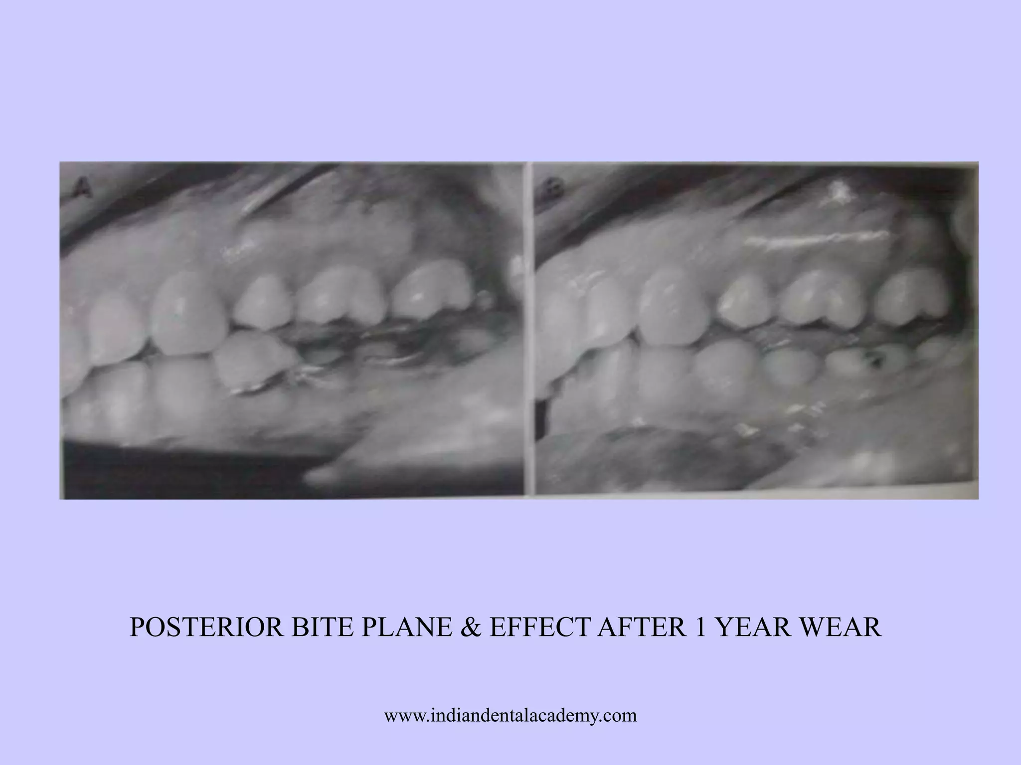 POSTERIOR BITE PLANE & EFFECT AFTER 1 YEAR WEAR
www.indiandentalacademy.com

 