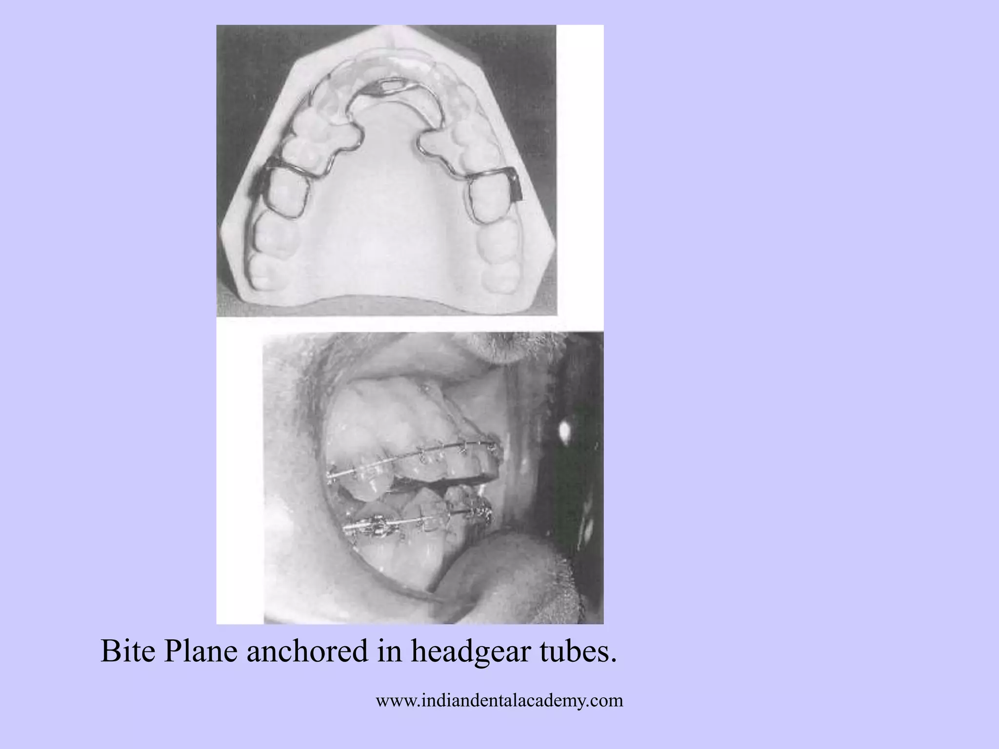 Bite Plane anchored in headgear tubes.
www.indiandentalacademy.com

 
