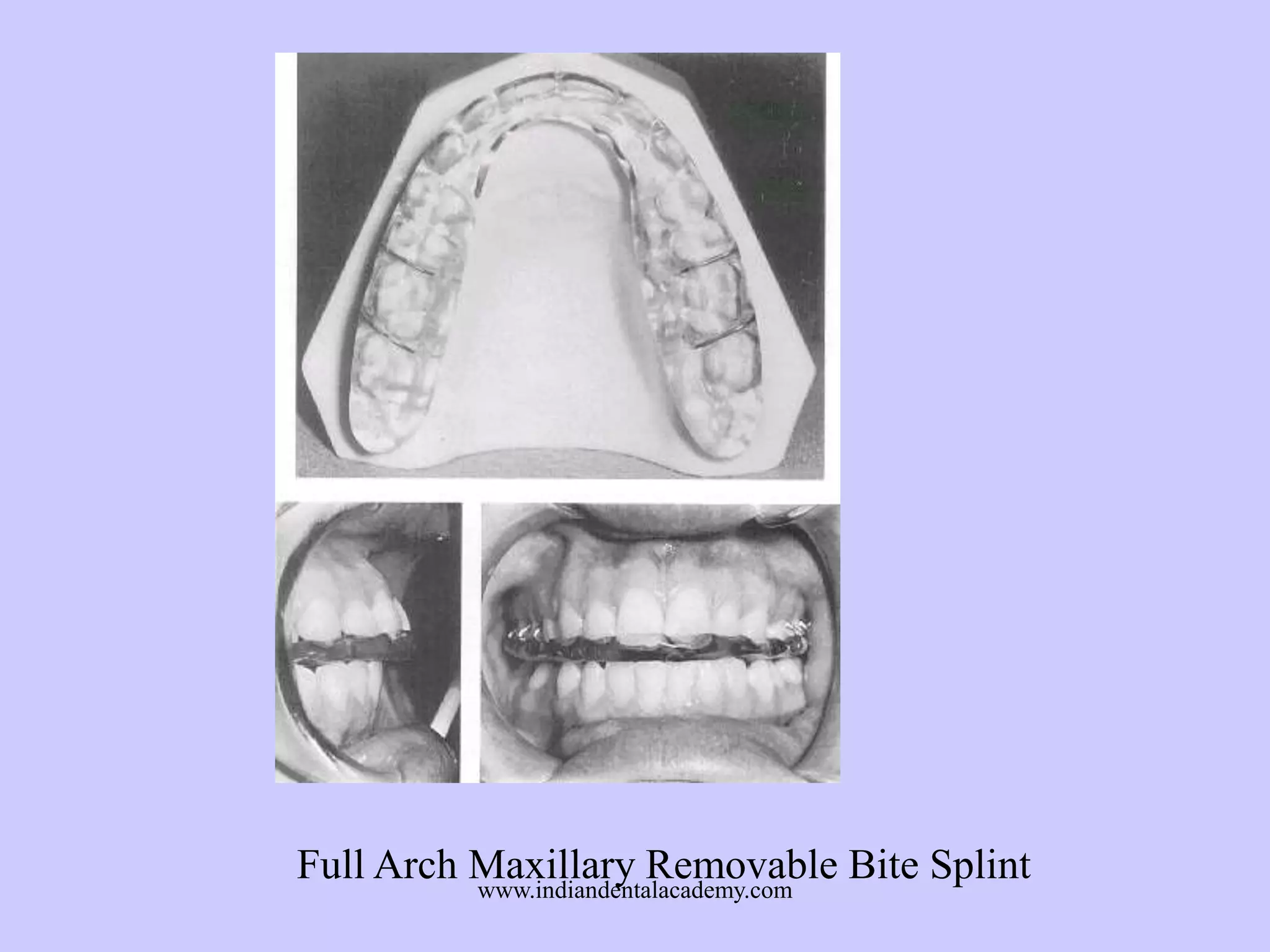 Full Arch Maxillary Removable Bite Splint
www.indiandentalacademy.com

 