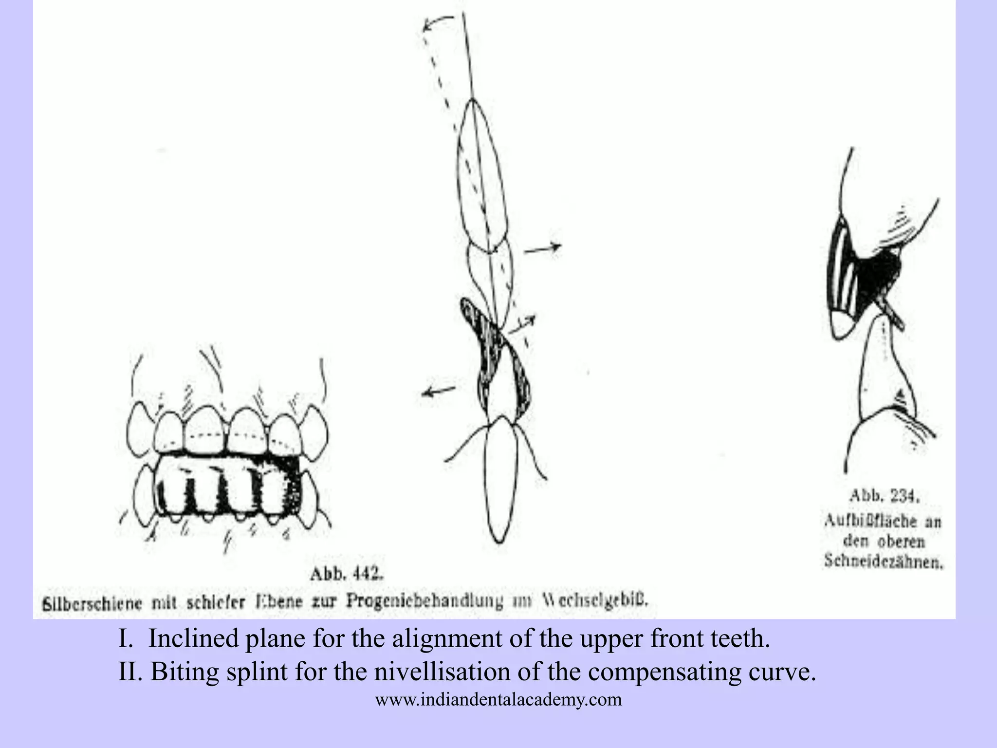 I. Inclined plane for the alignment of the upper front teeth.
II. Biting splint for the nivellisation of the compensating curve.
www.indiandentalacademy.com

 