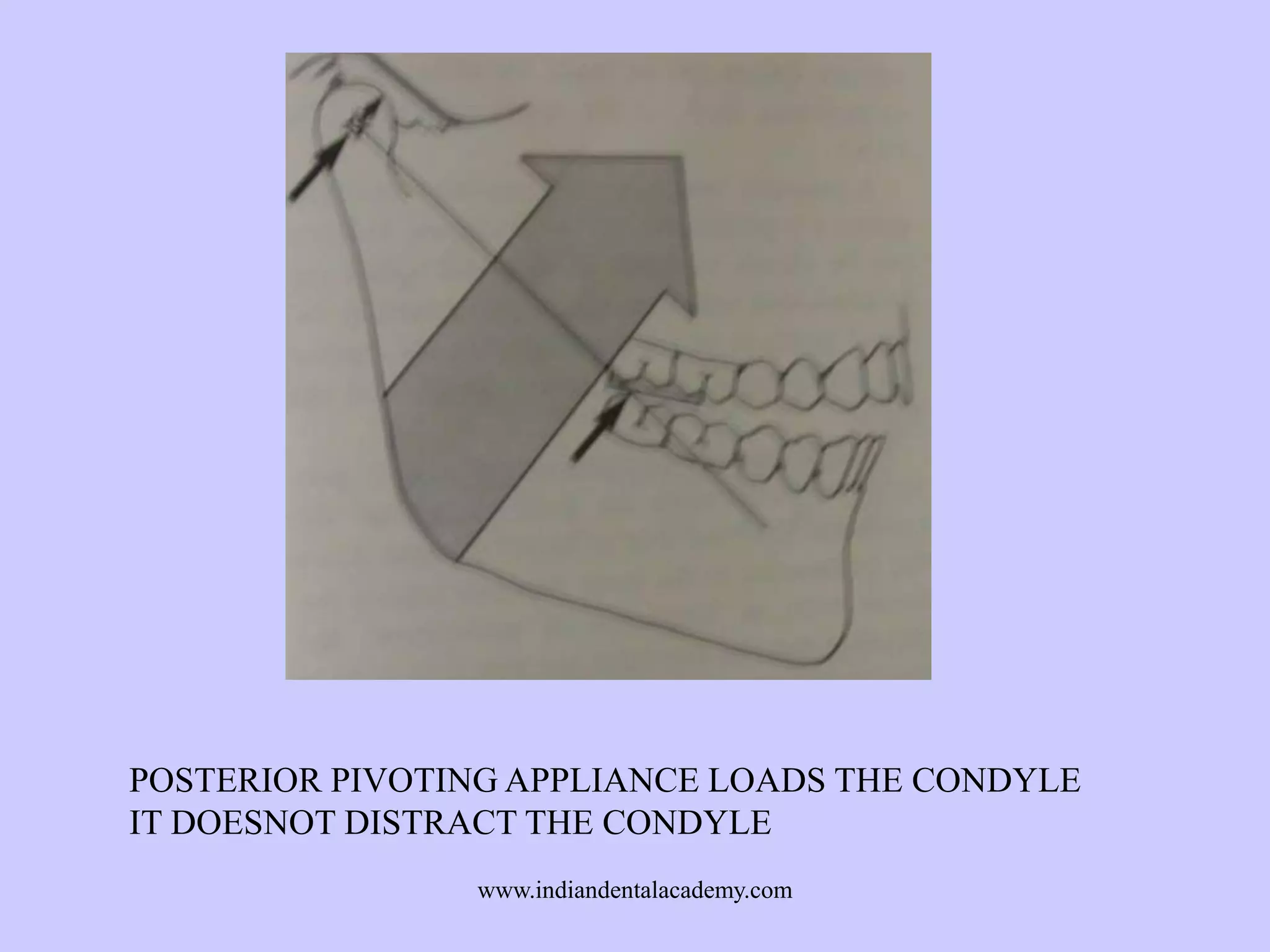 POSTERIOR PIVOTING APPLIANCE LOADS THE CONDYLE
IT DOESNOT DISTRACT THE CONDYLE
www.indiandentalacademy.com

 
