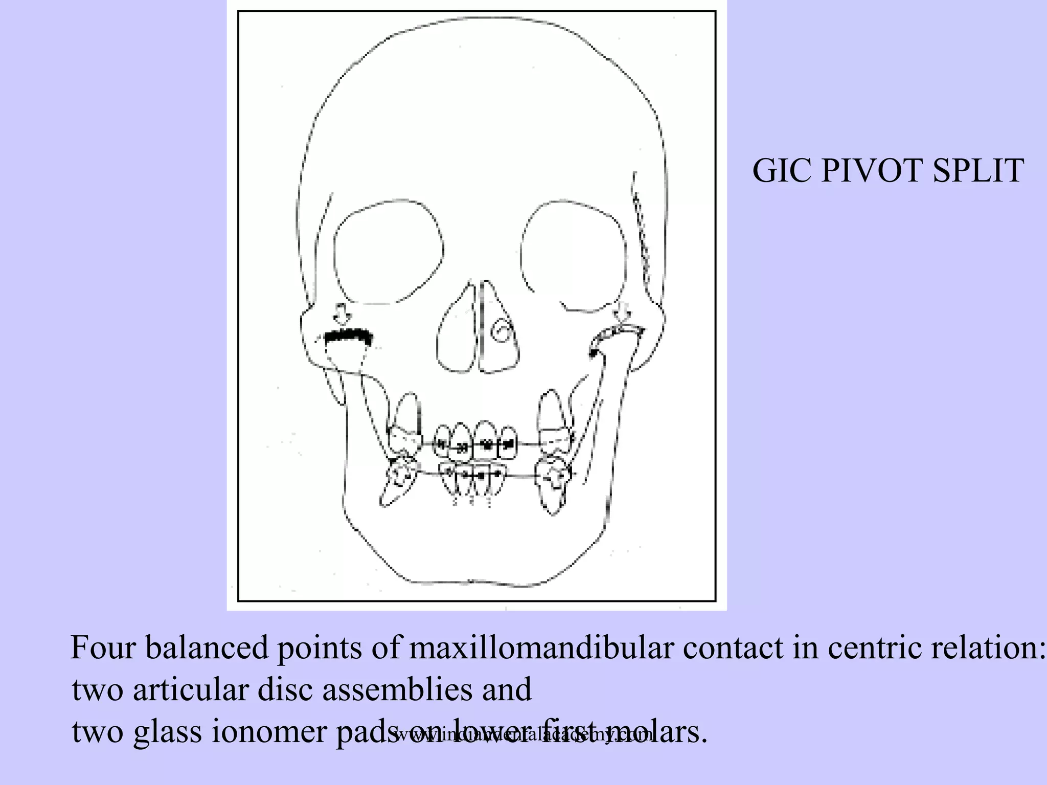 GIC PIVOT SPLIT

Four balanced points of maxillomandibular contact in centric relation:
two articular disc assemblies and
two glass ionomer padswww.indiandentalacademy.com
on lower first molars.

 